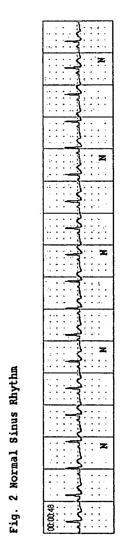 Method and apparatus for detecting artifact signals in the electrocardiogram of a patient caused by CPR and/or patient motion using patient impedance