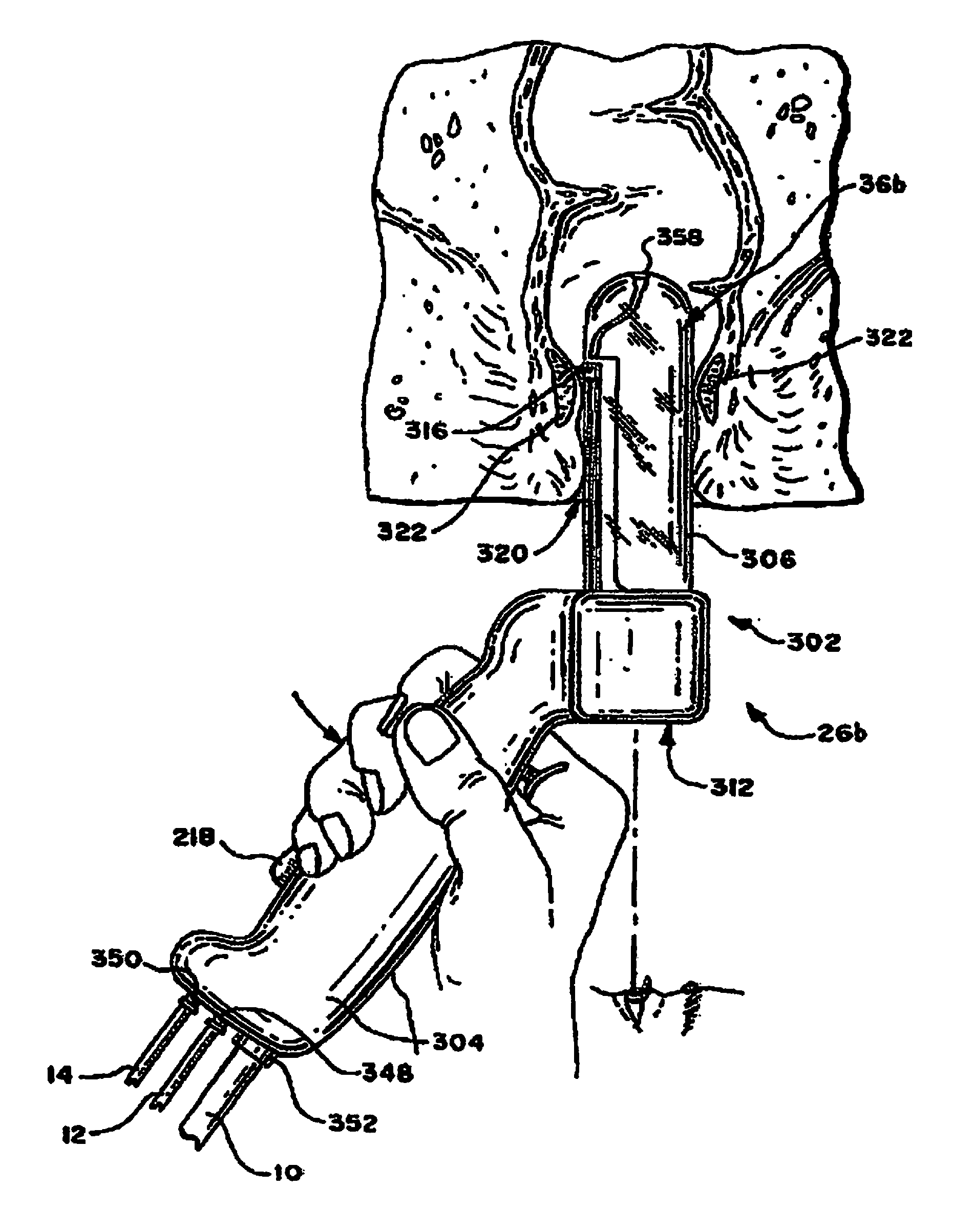 Systems and methods for treating tissue with radiofrequency energy