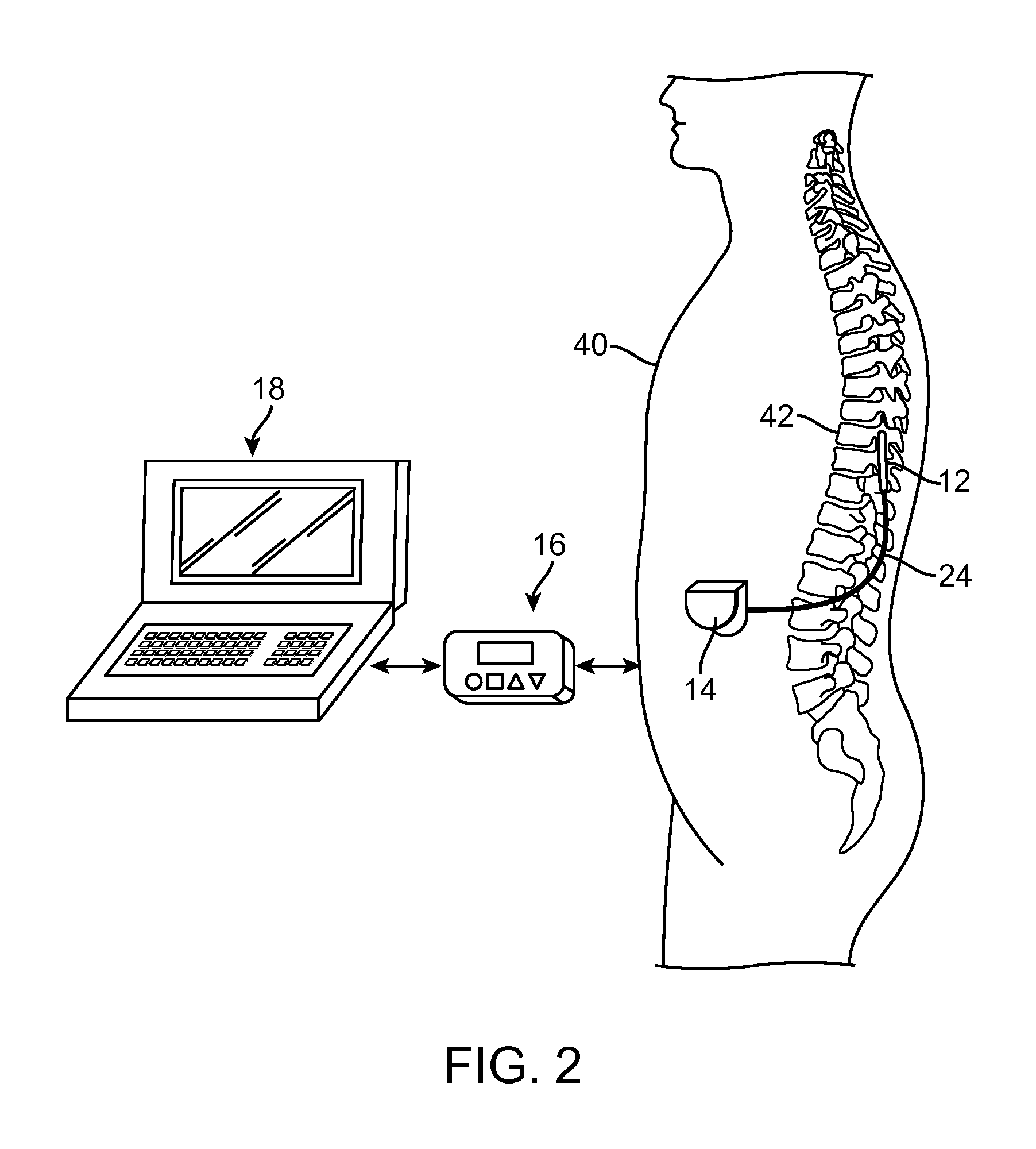 Multi-channel neuromodulation system having frequency modulation stimulation