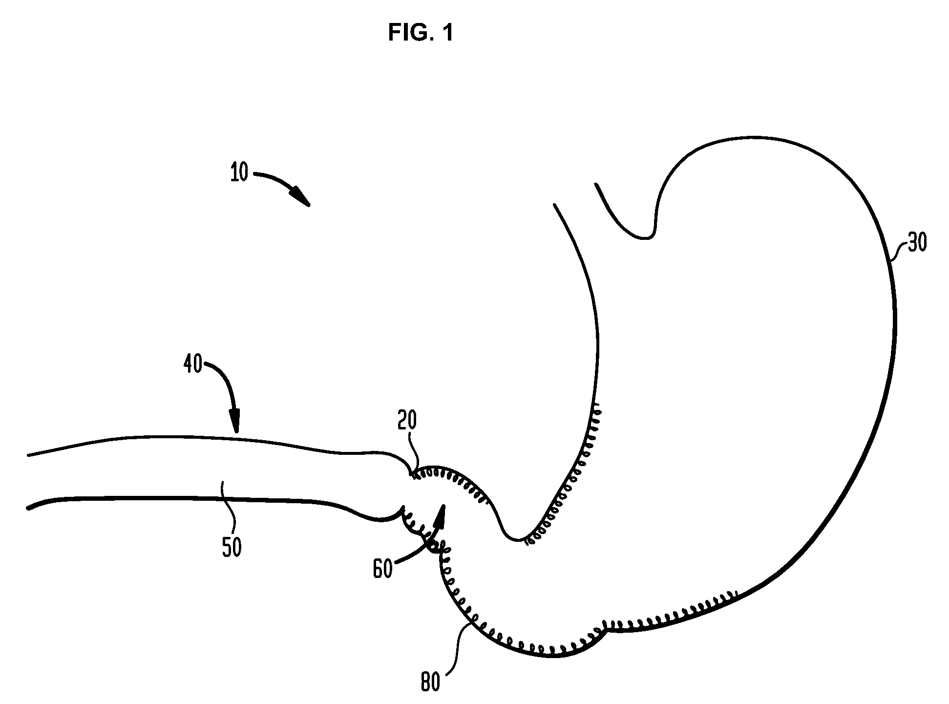 Systems and methods for treatment of obesity and type 2 diabetes