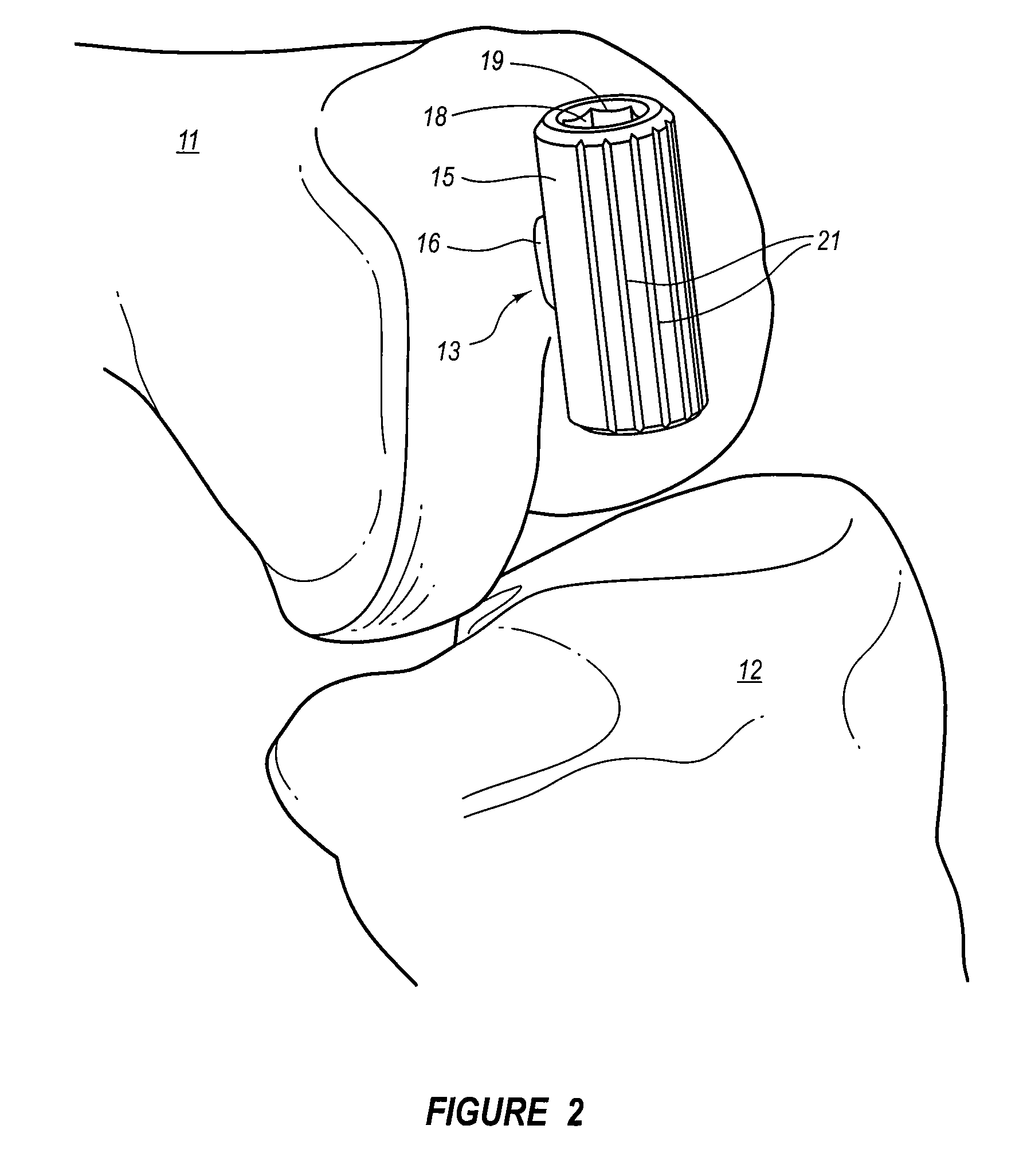 Arthroplasty systems and methods for optimally aligning and tensioning a knee prosthesis