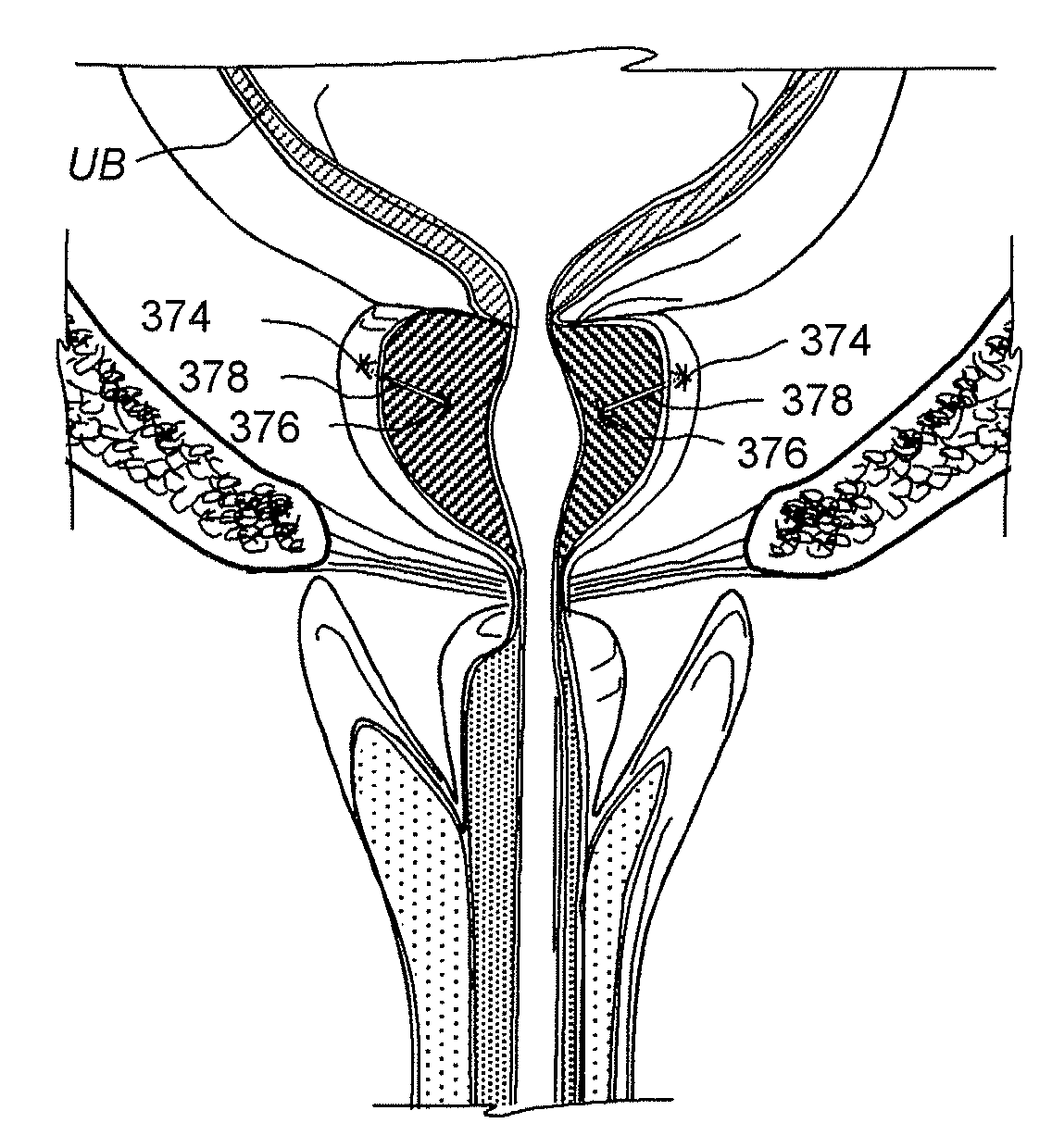 Devices, systems and methods for treating benign prostatic hyperplasia and other conditions