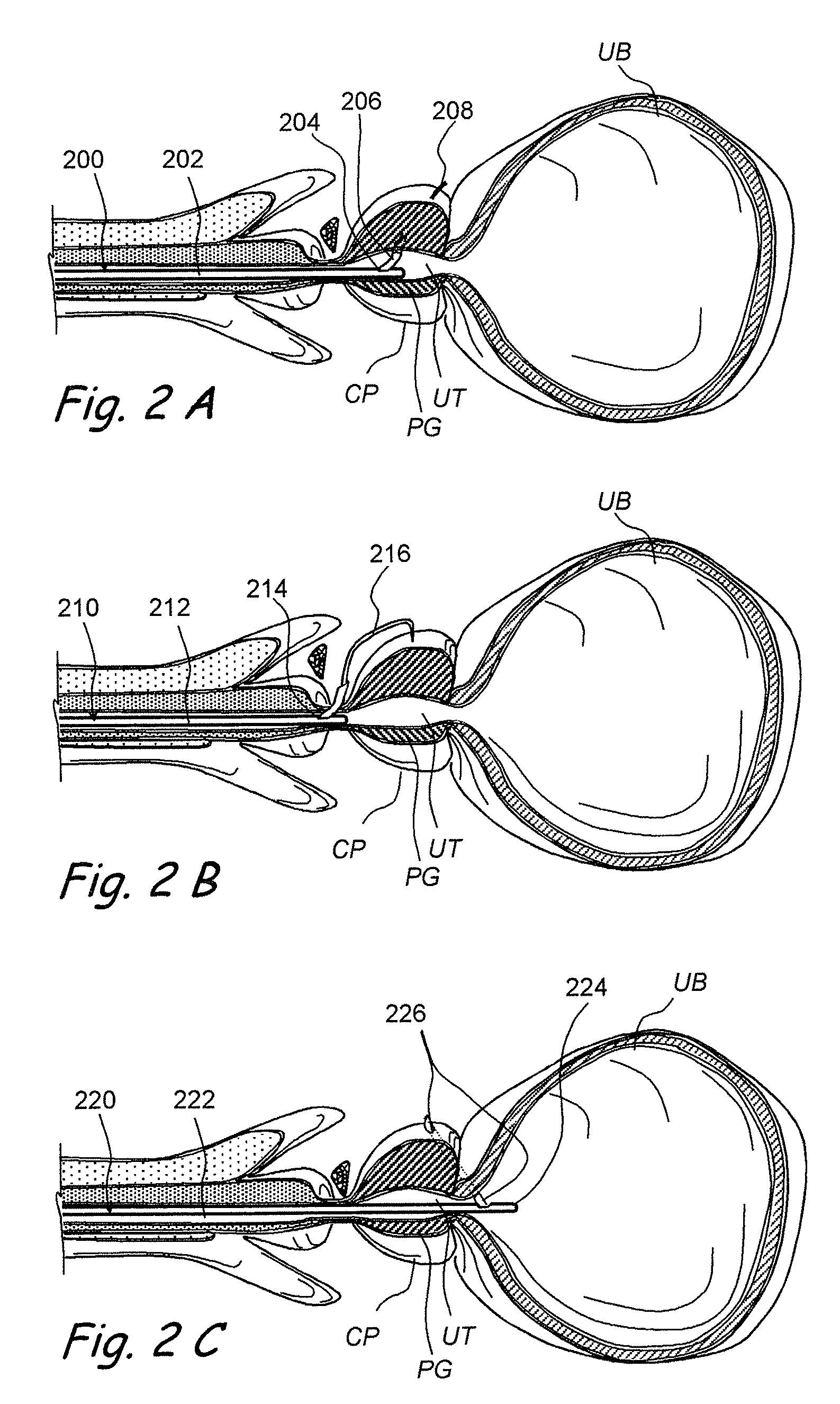 Devices, systems and methods for treating benign prostatic hyperplasia and other conditions