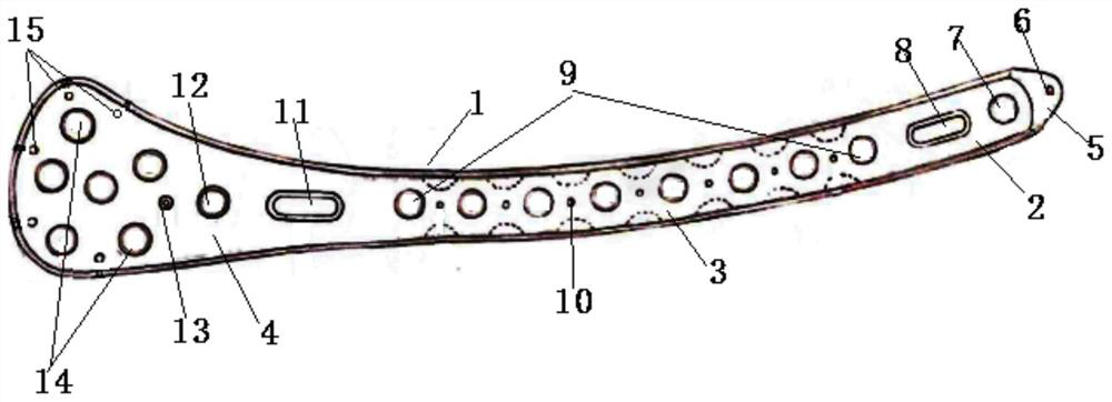 Thighbone far-end outer side bone fracture plate