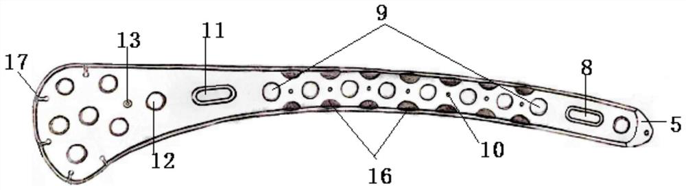 Thighbone far-end outer side bone fracture plate