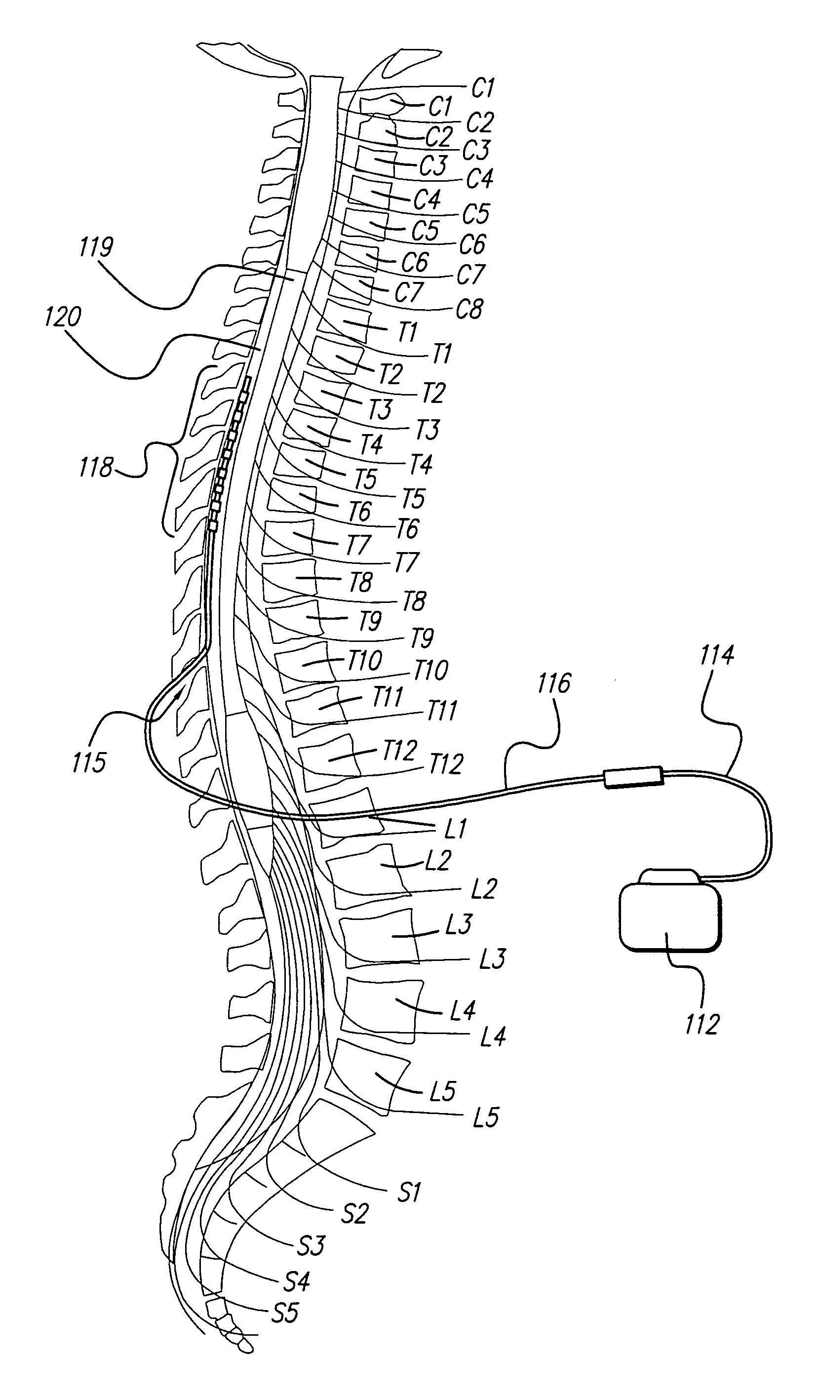 Forward masking method for estimating neural response