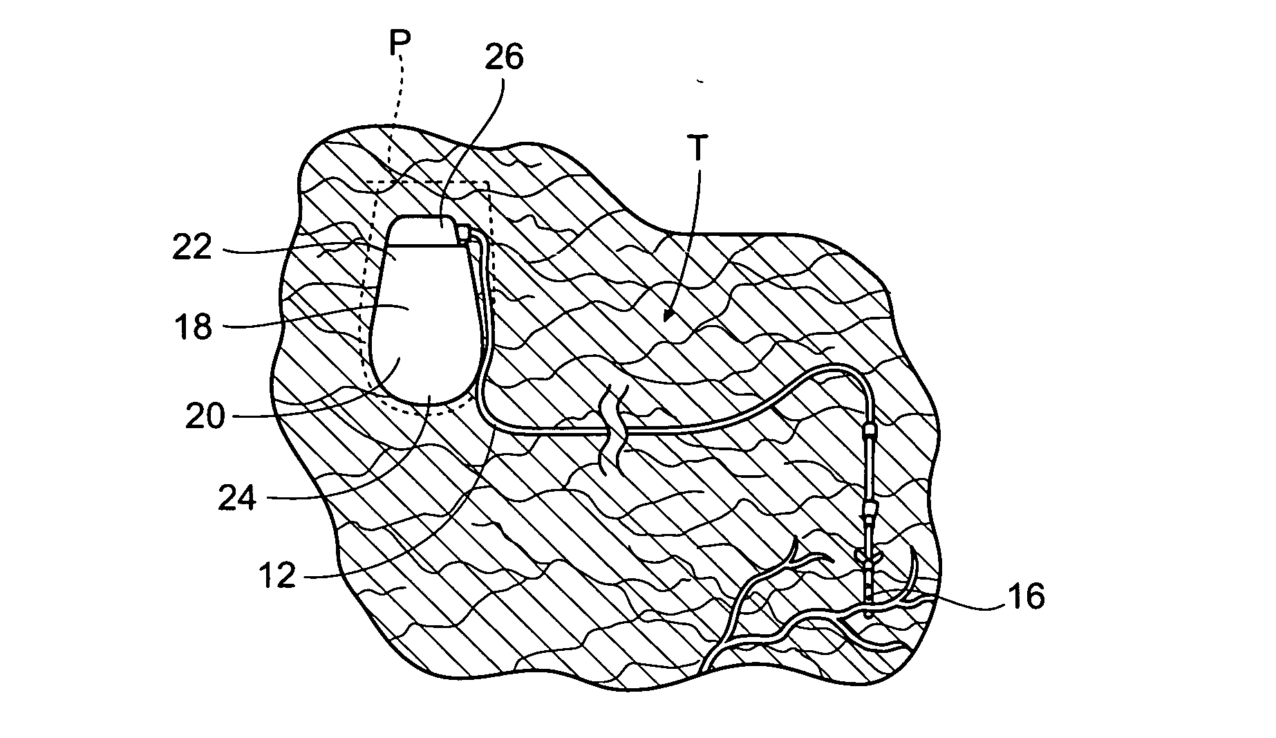 Implantable pulse generator systems and methods for providing functional and/or therapeutic stimulation of muscles and/or nerves and/or central nervous system tissue