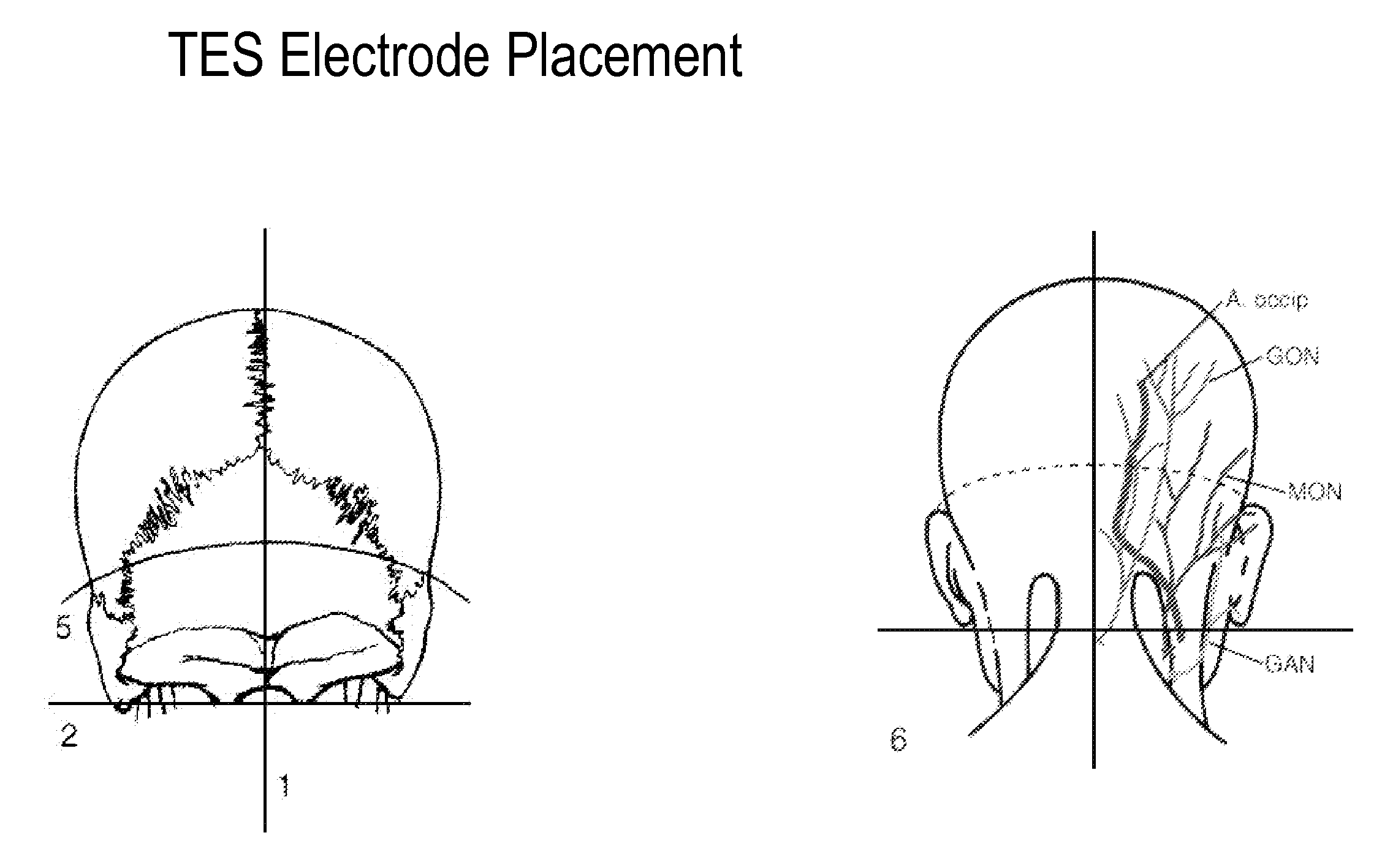 Eliciting analgesia by transcranial electrical stimulation