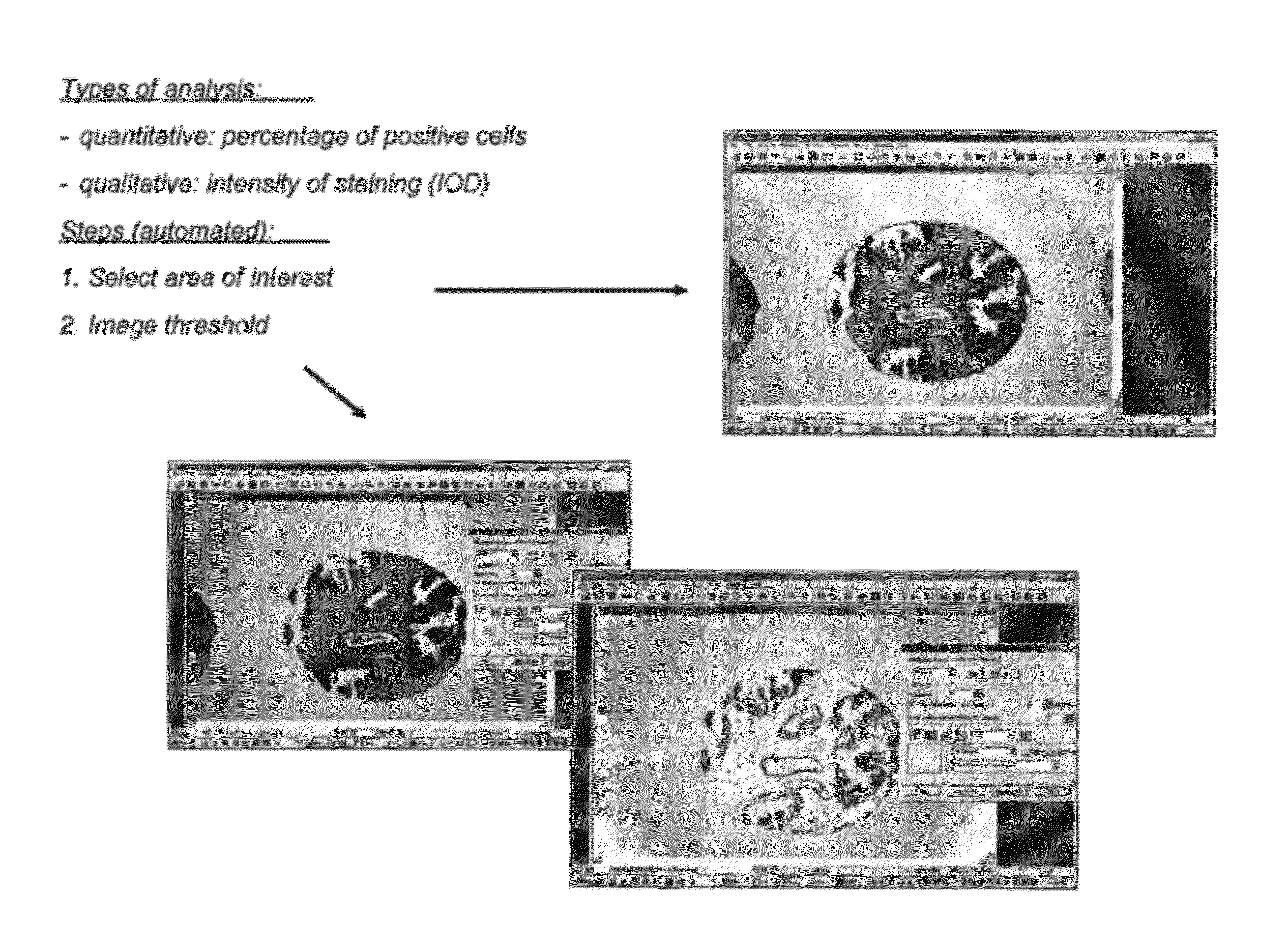 Methods for diagnosis and treatment of endometrial cancer