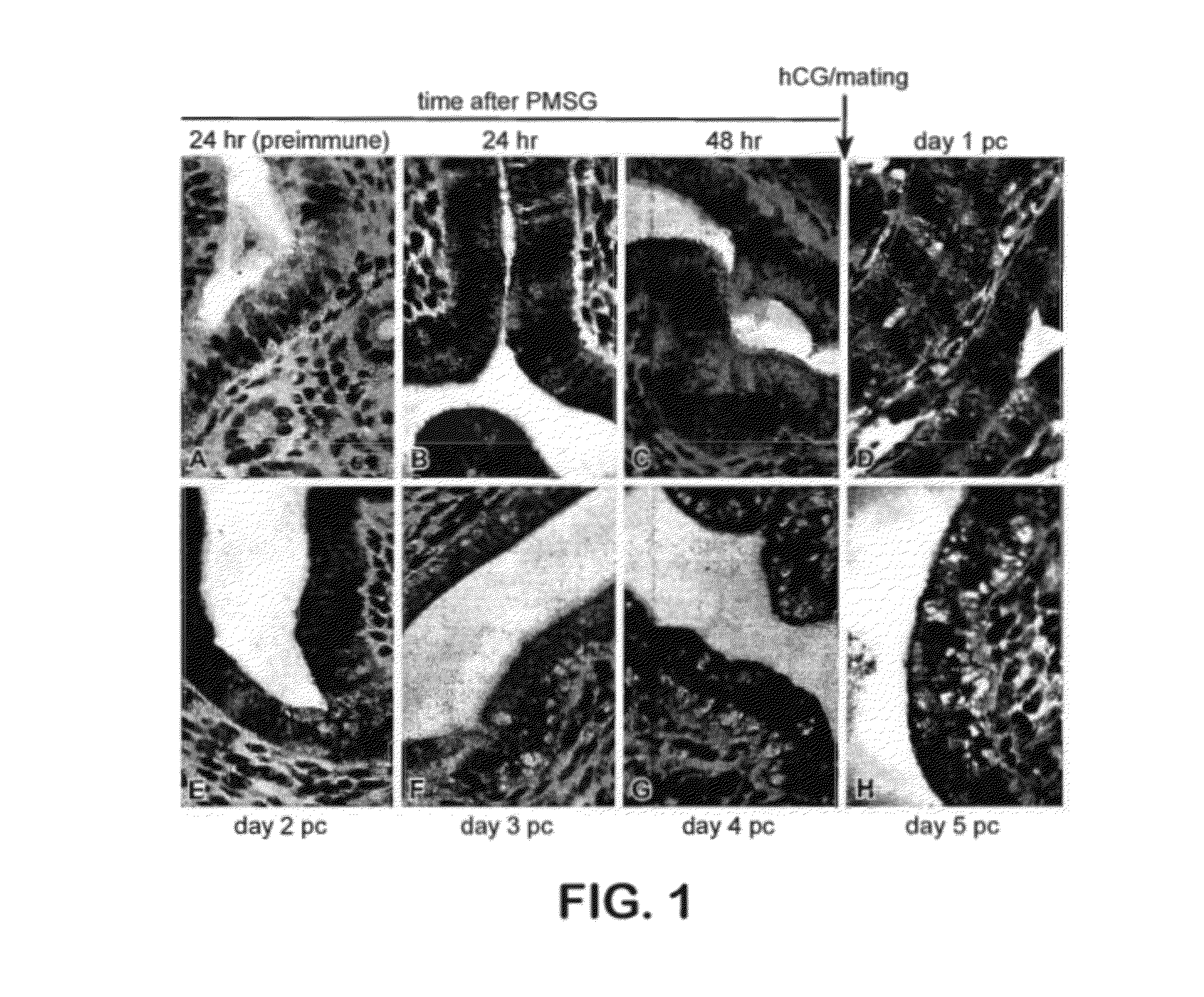 Methods for diagnosis and treatment of endometrial cancer