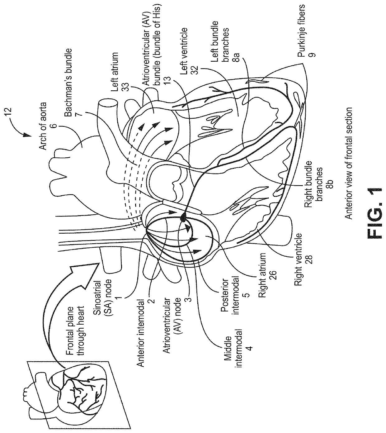 His bundle and bundle branch pacing adjustment