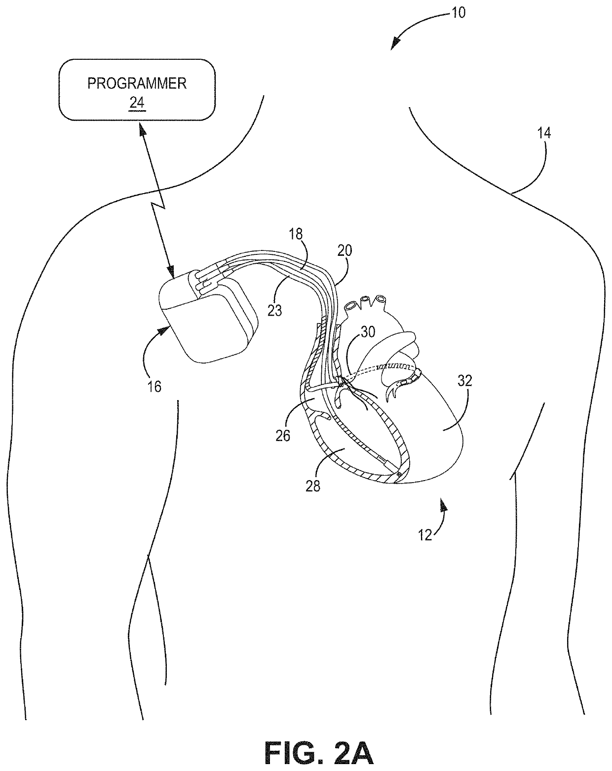 His bundle and bundle branch pacing adjustment