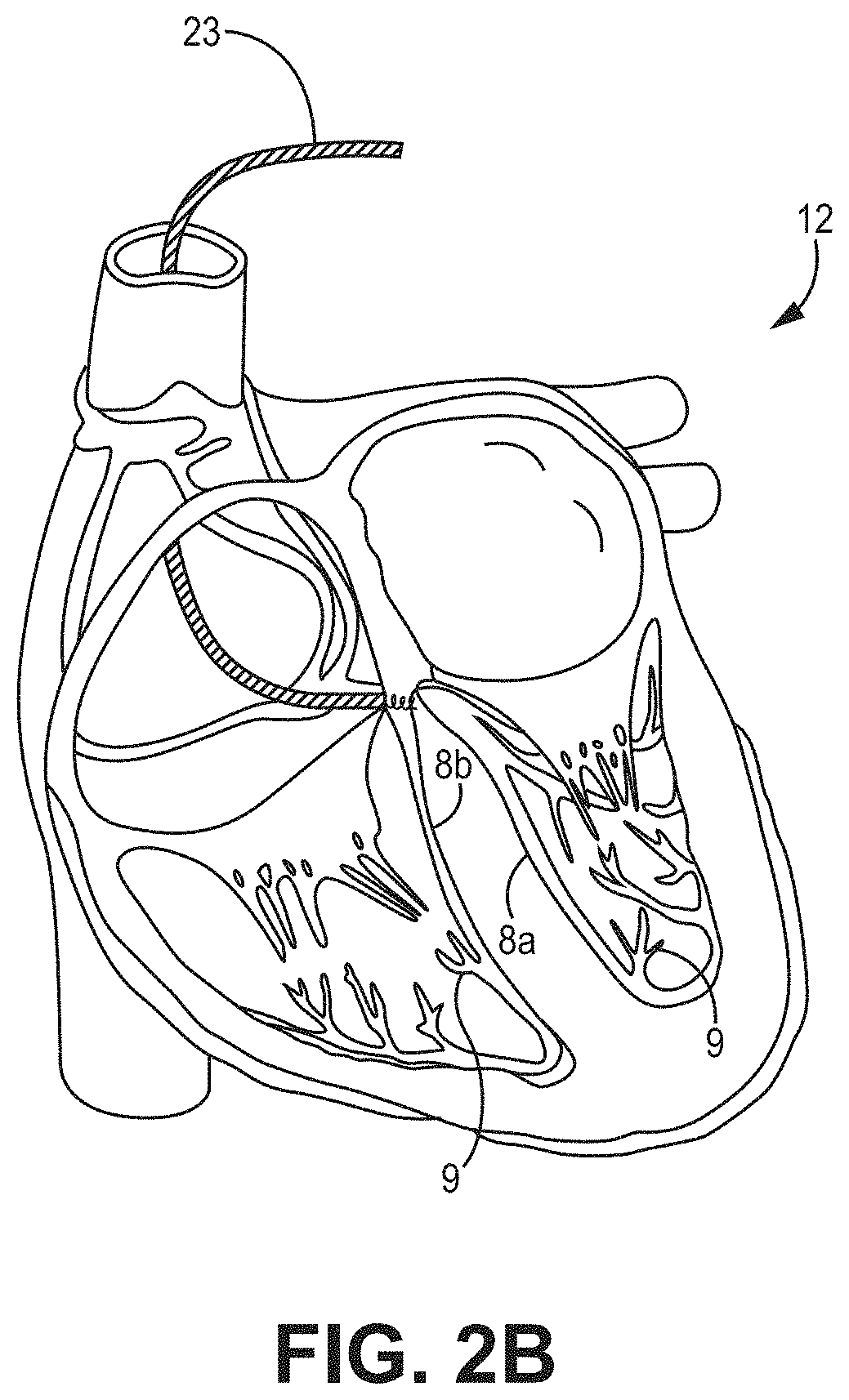 His bundle and bundle branch pacing adjustment