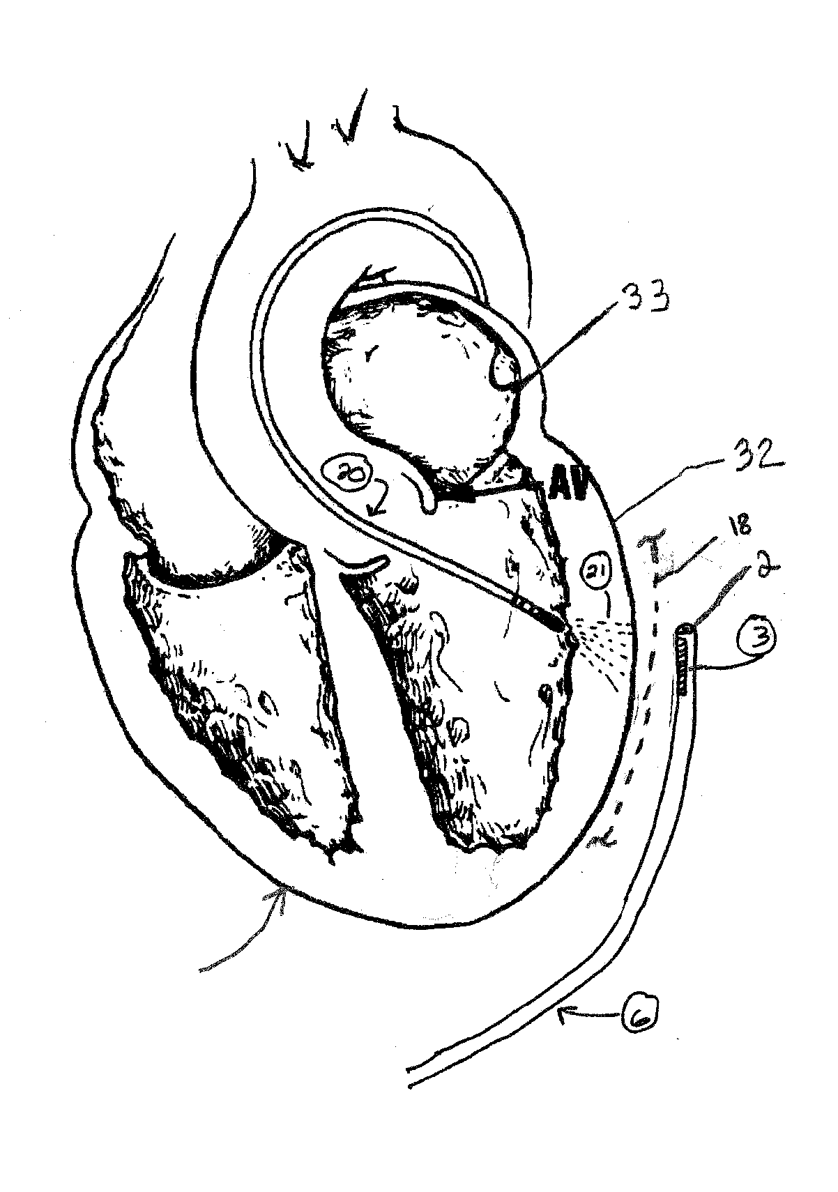 Electrode Catheter for Ablation Purposes and Related Method Thereof