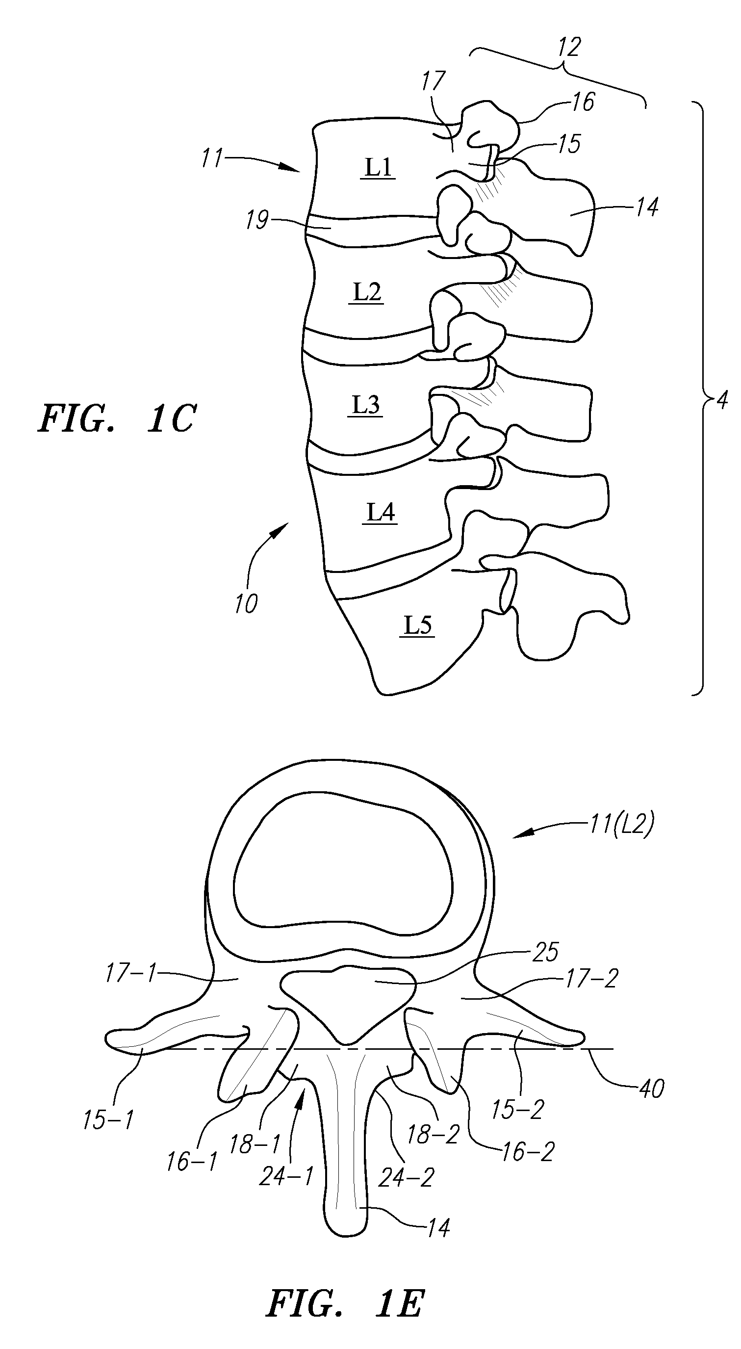 Systems, Methods And Devices For Correcting Spinal Deformities