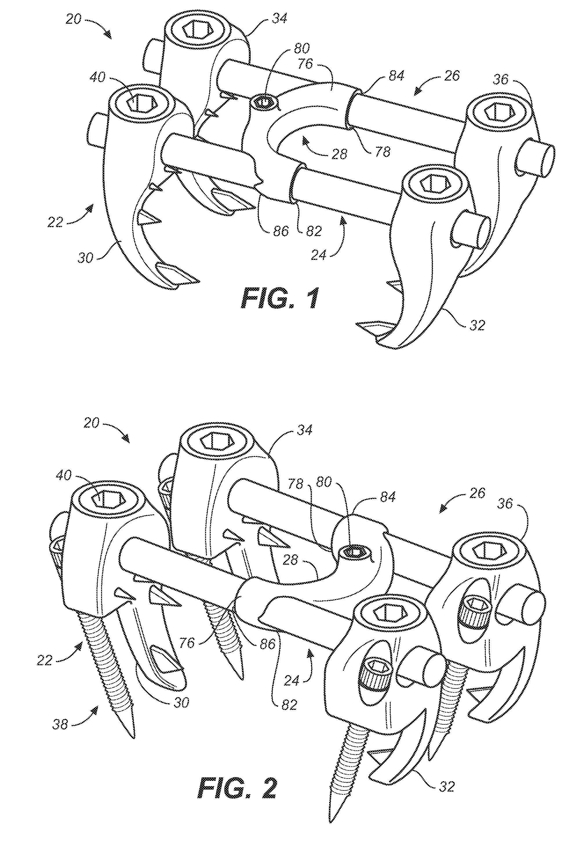 Implant system and method to treat degenerative disorders of the spine