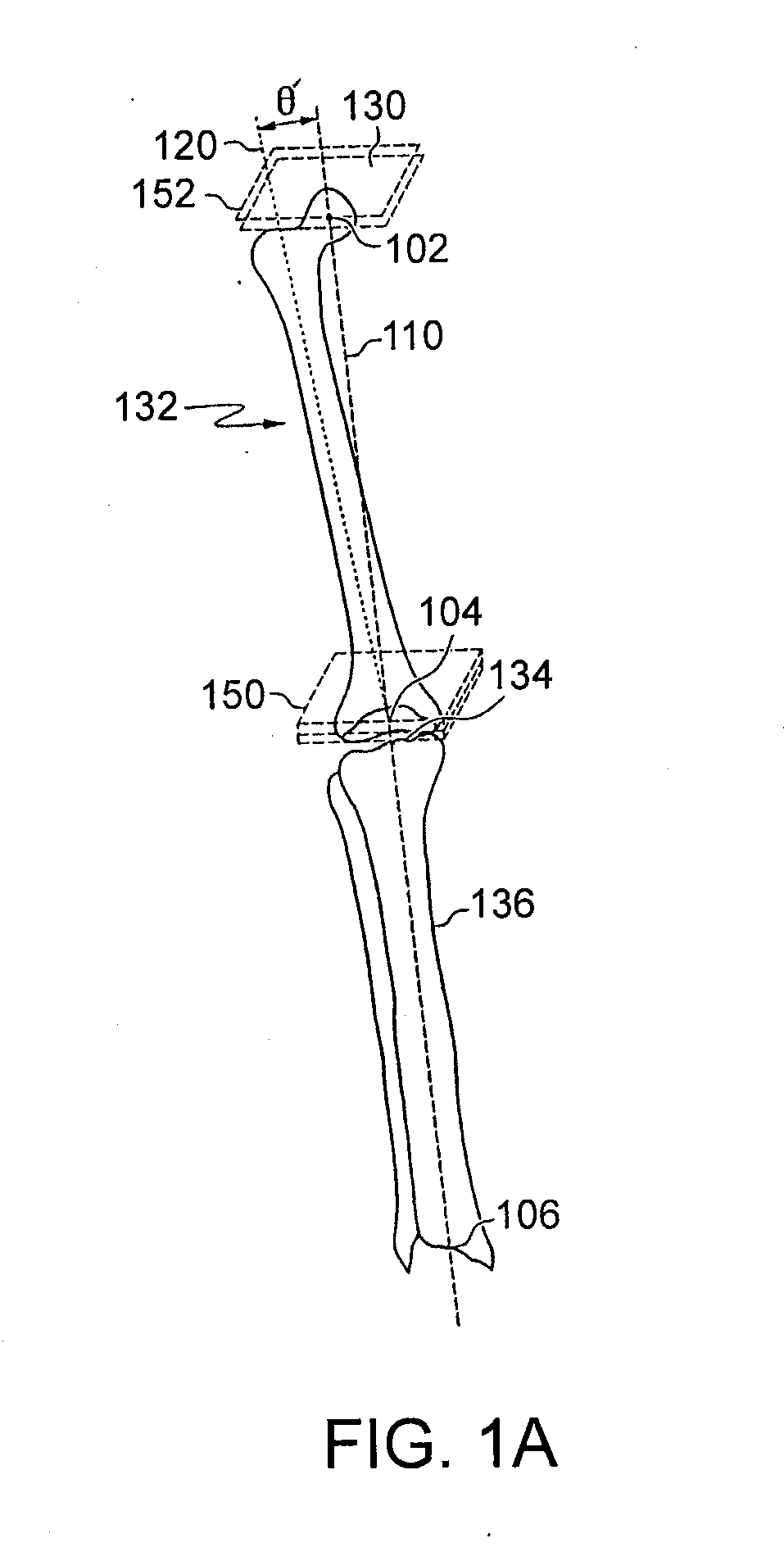Surgical Tools Facilitating Increased Accuracy, Speed and Simplicity in Performing Joint Arthroplasty