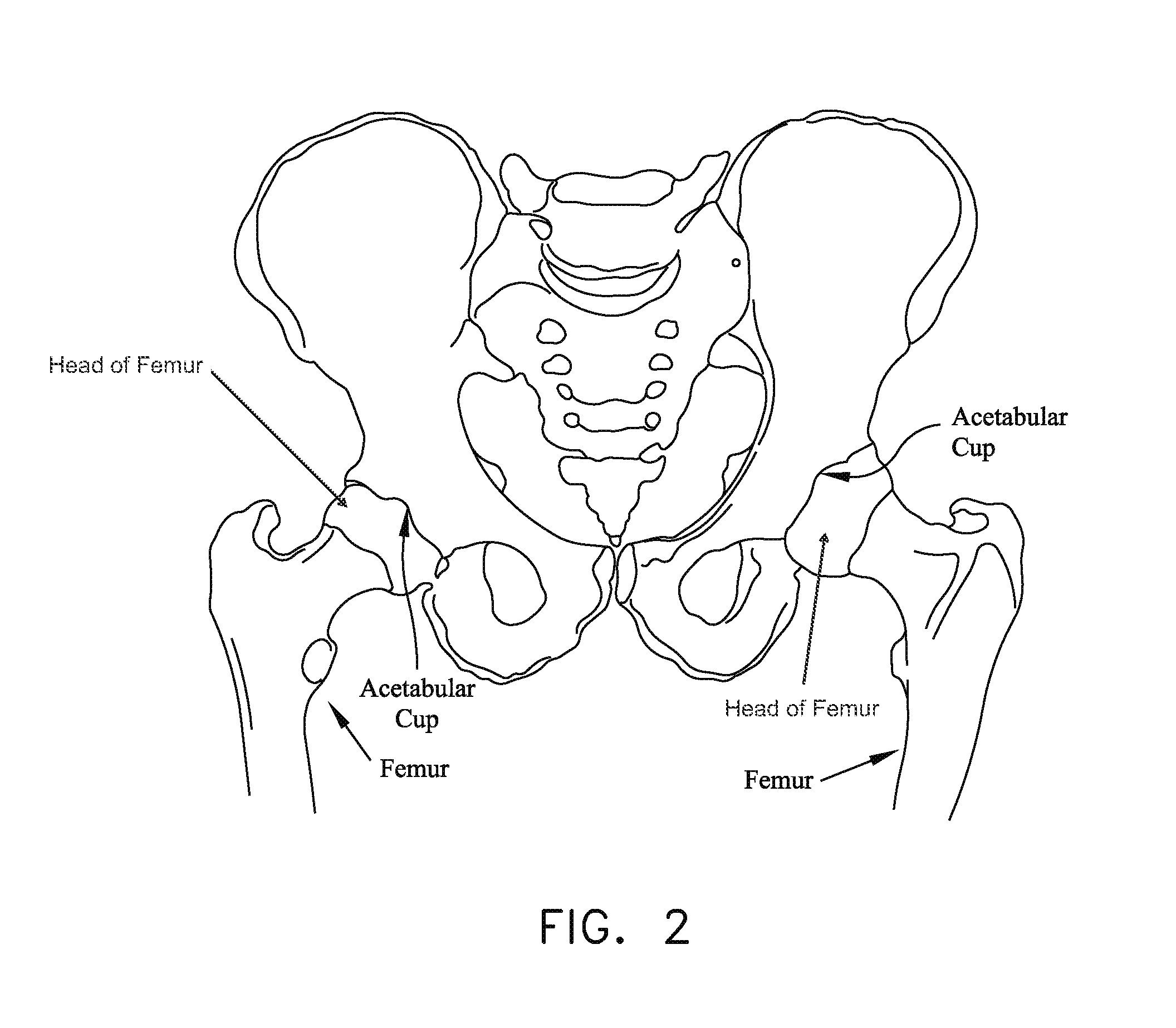 Method and apparatus for distracting a joint, including the provision and use of a novel fluid joint spacer