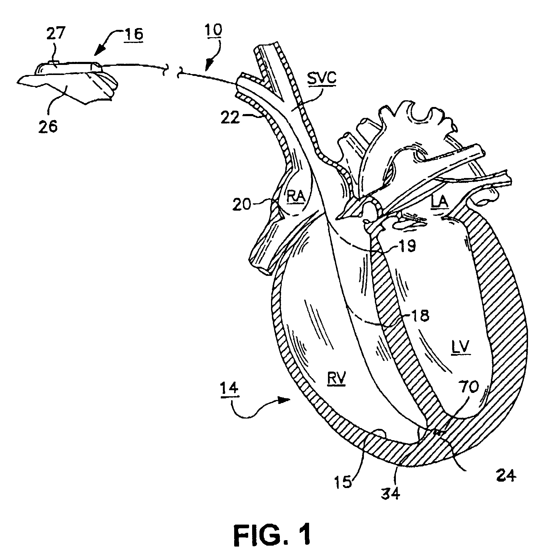 Bilumen guide catheters for accessing cardiac sites