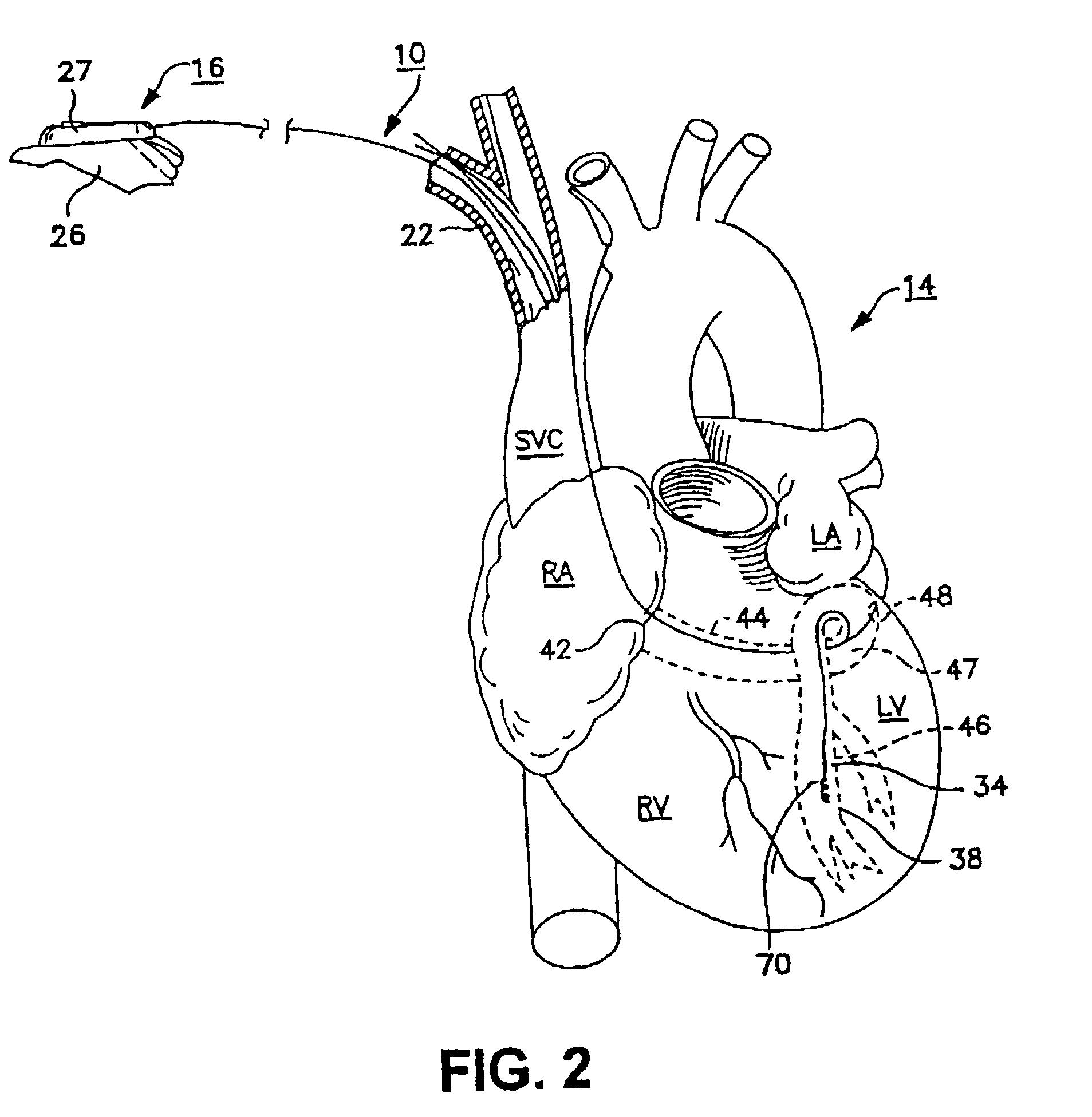 Bilumen guide catheters for accessing cardiac sites