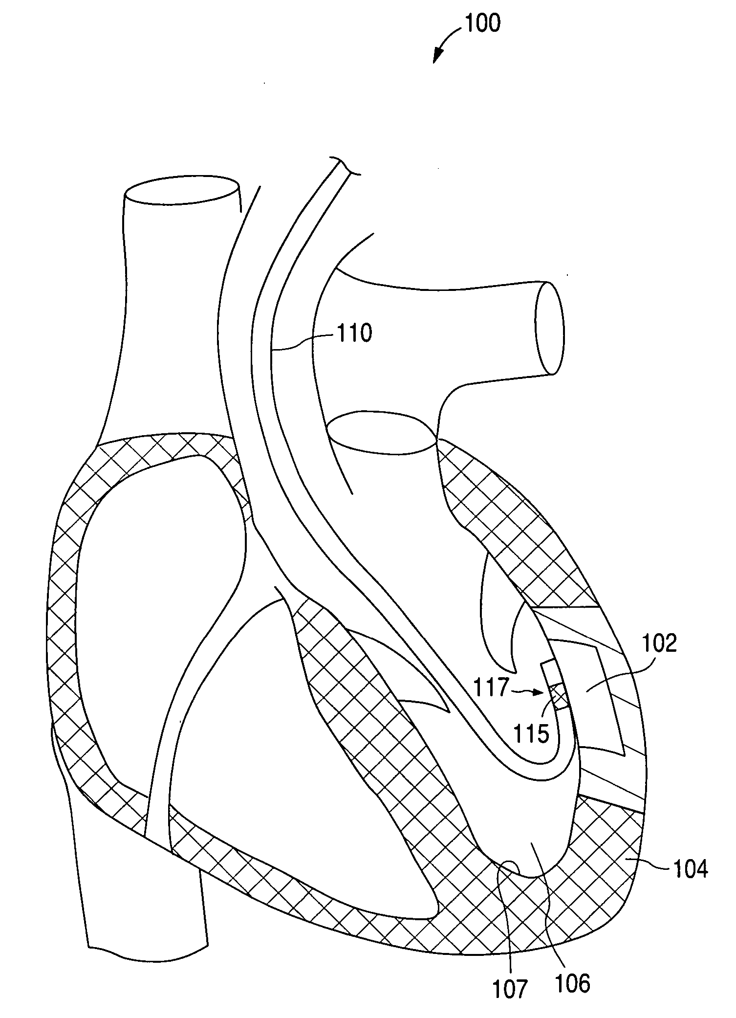 Ultrasound energy driven intraventricular catheter to treat ischemia