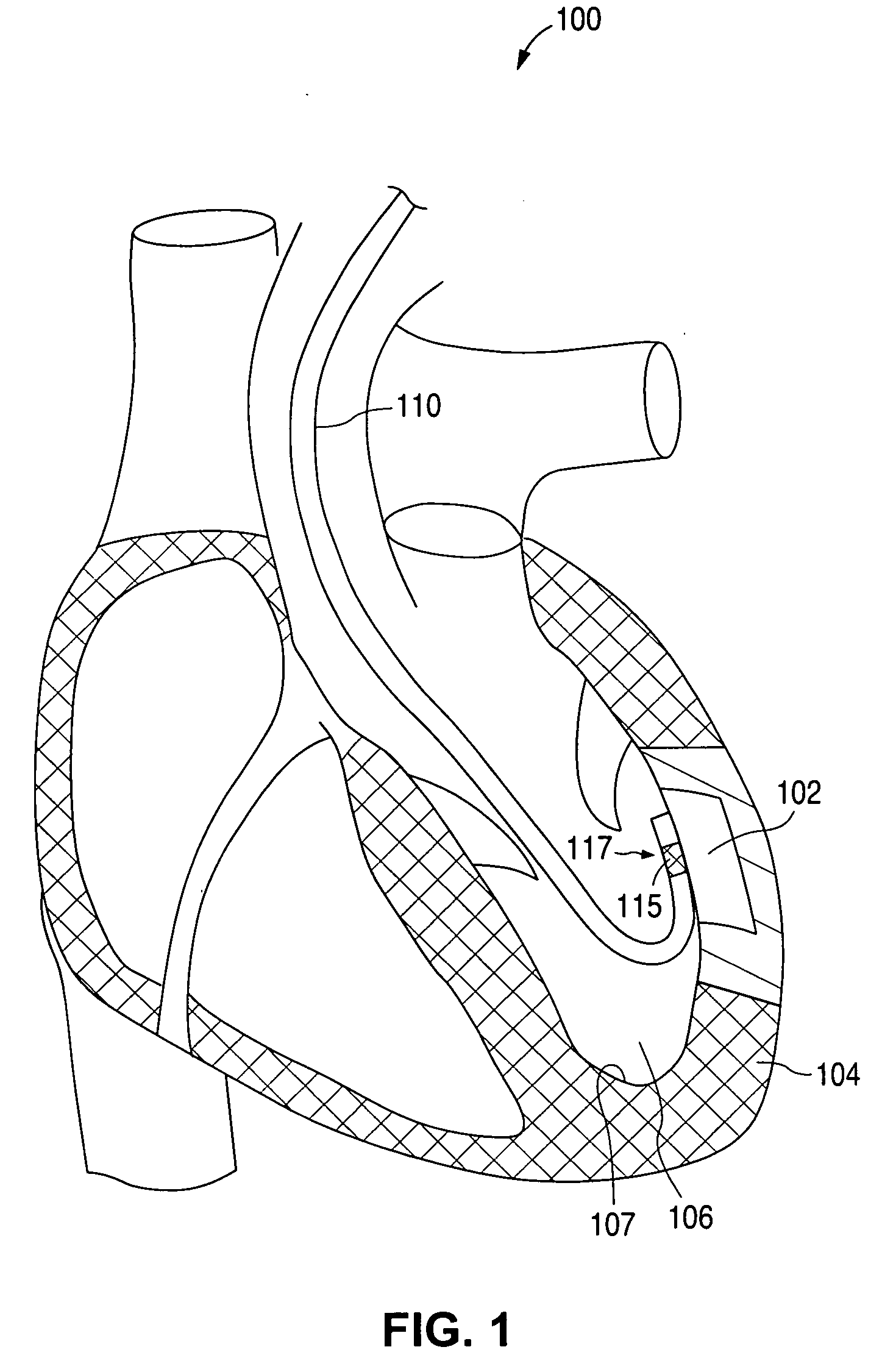 Ultrasound energy driven intraventricular catheter to treat ischemia