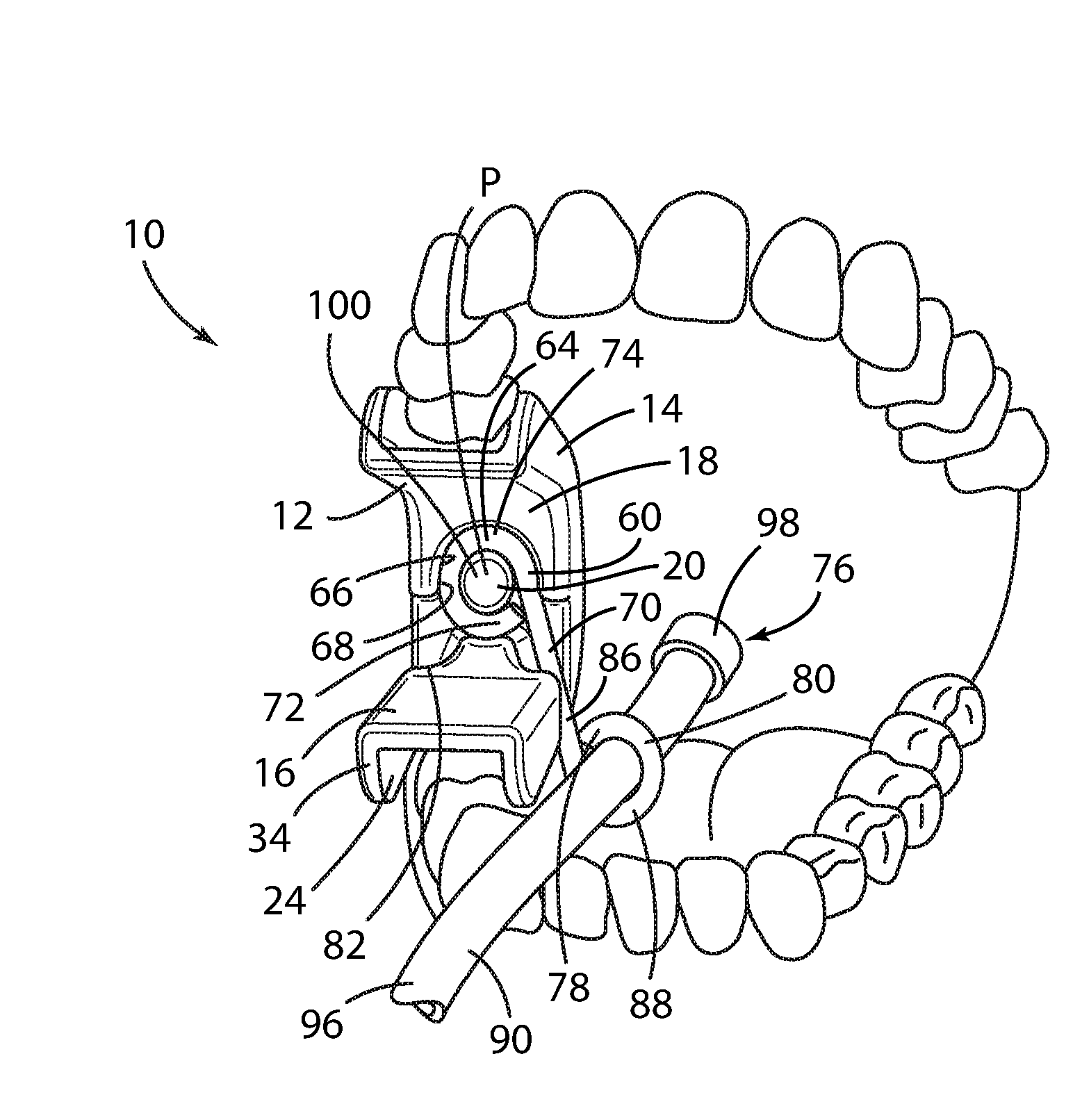 Dental bite block assembly