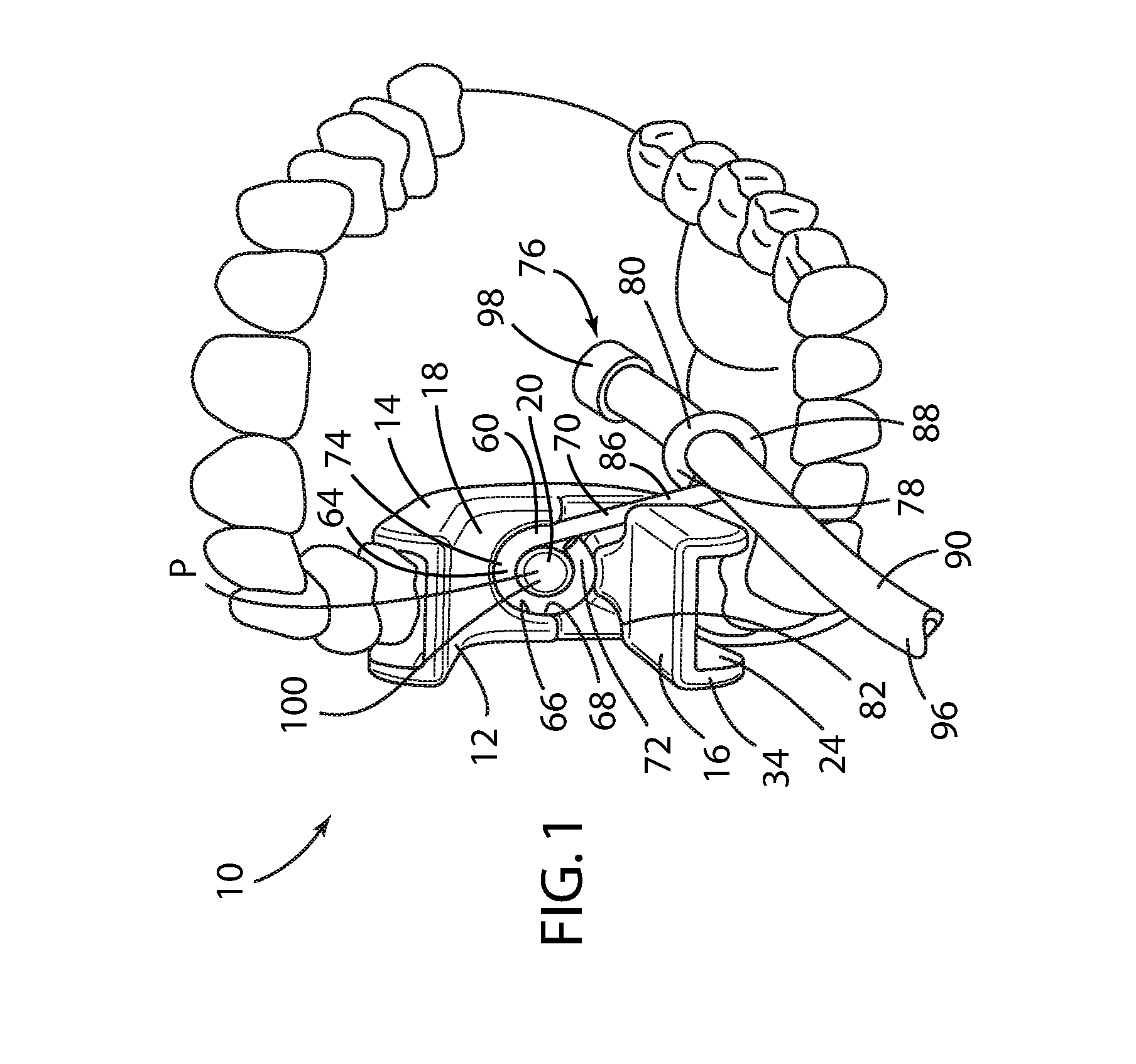 Dental bite block assembly