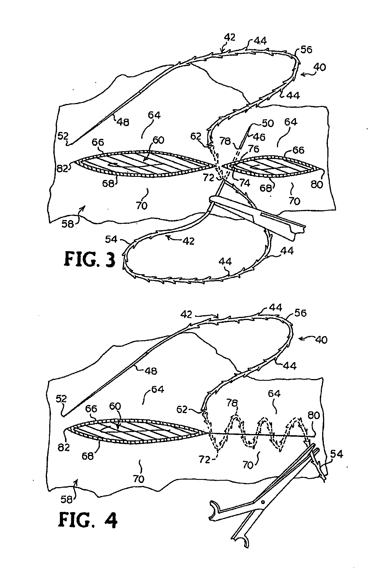 Suture Method