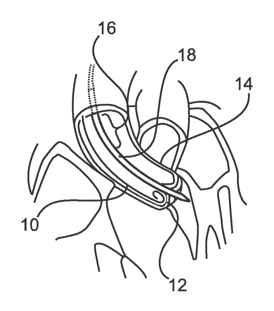 A medical placement alarm