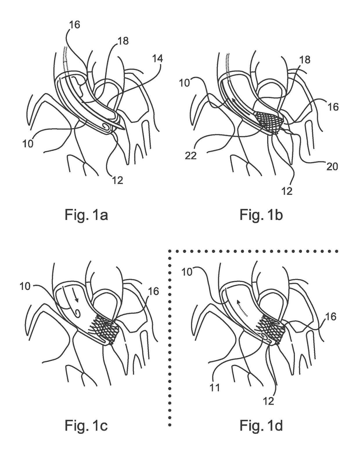 A medical placement alarm