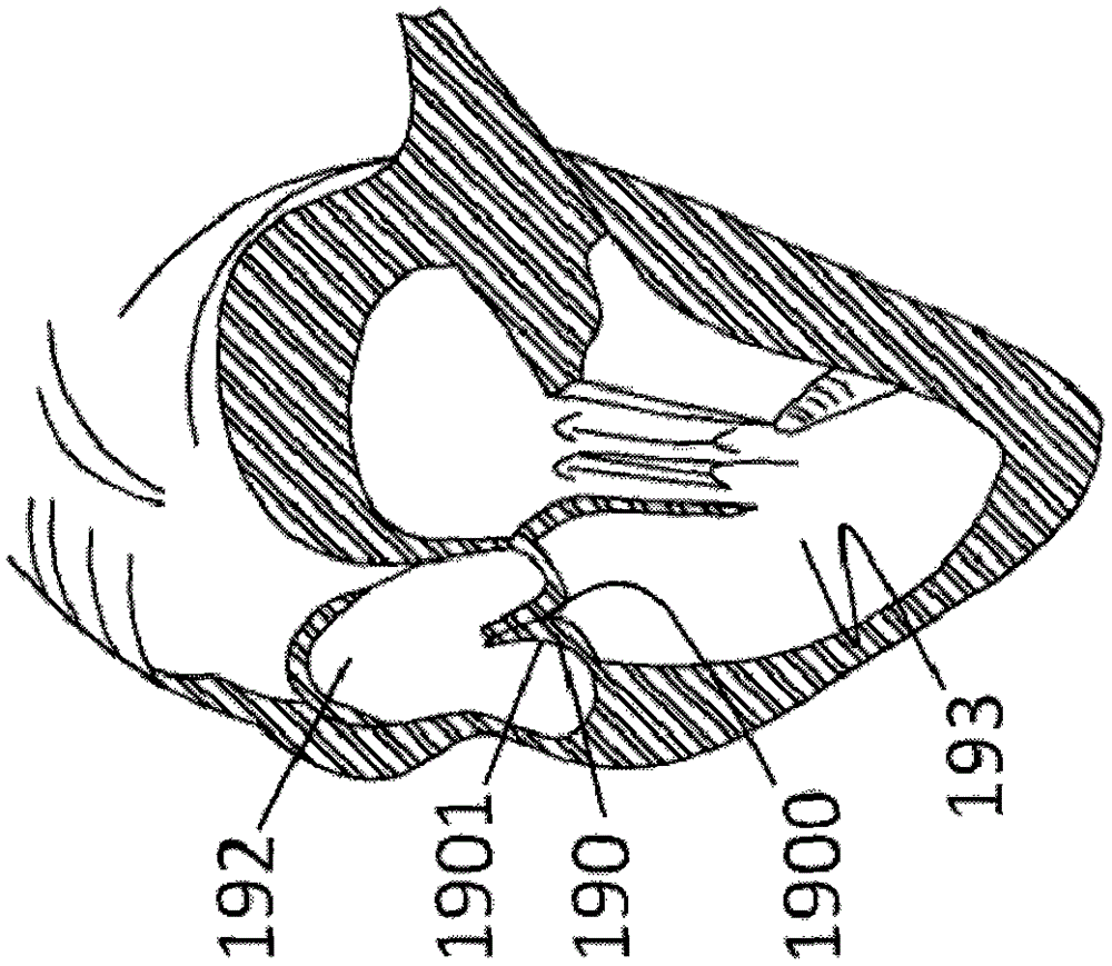 Artificial valve prosthesis with leaflet clamping device