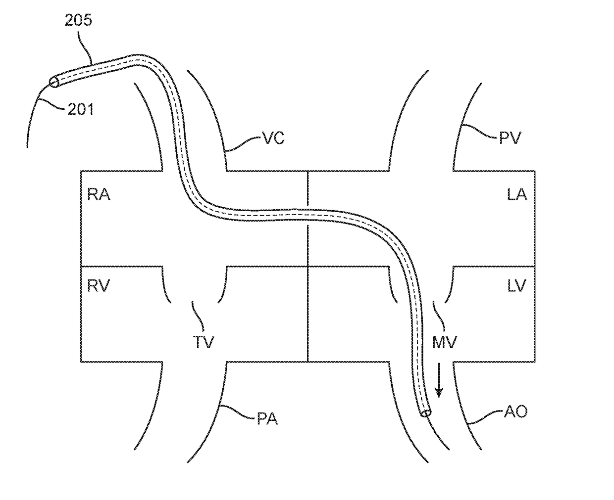 Antegrade hemodynamic support