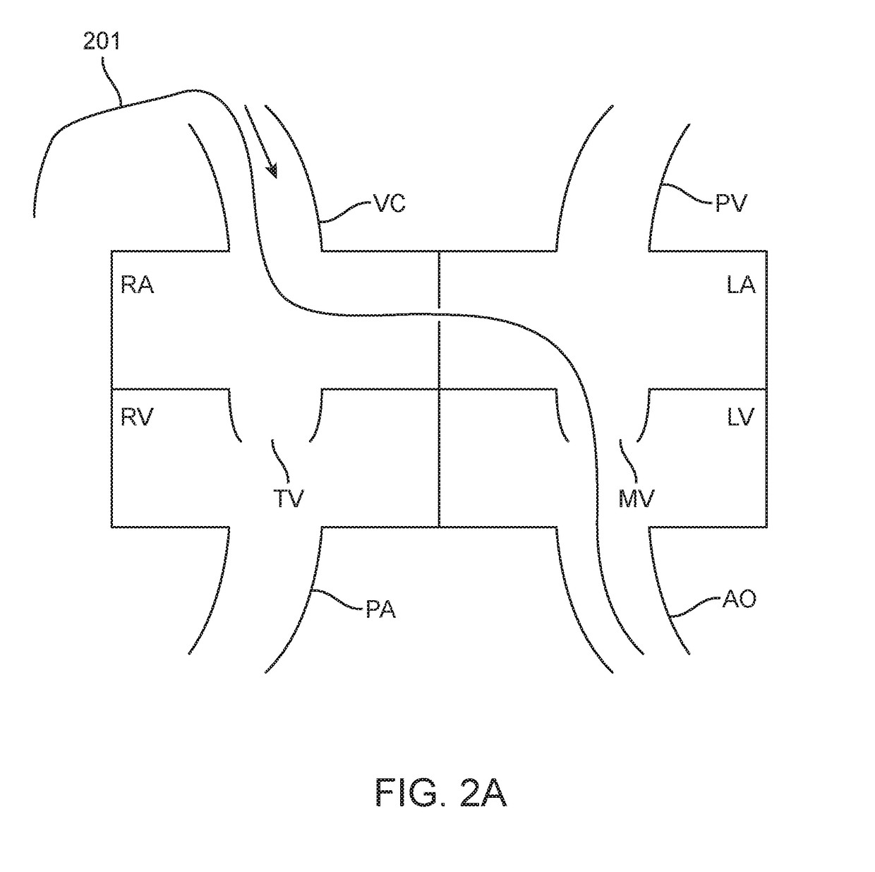 Antegrade hemodynamic support