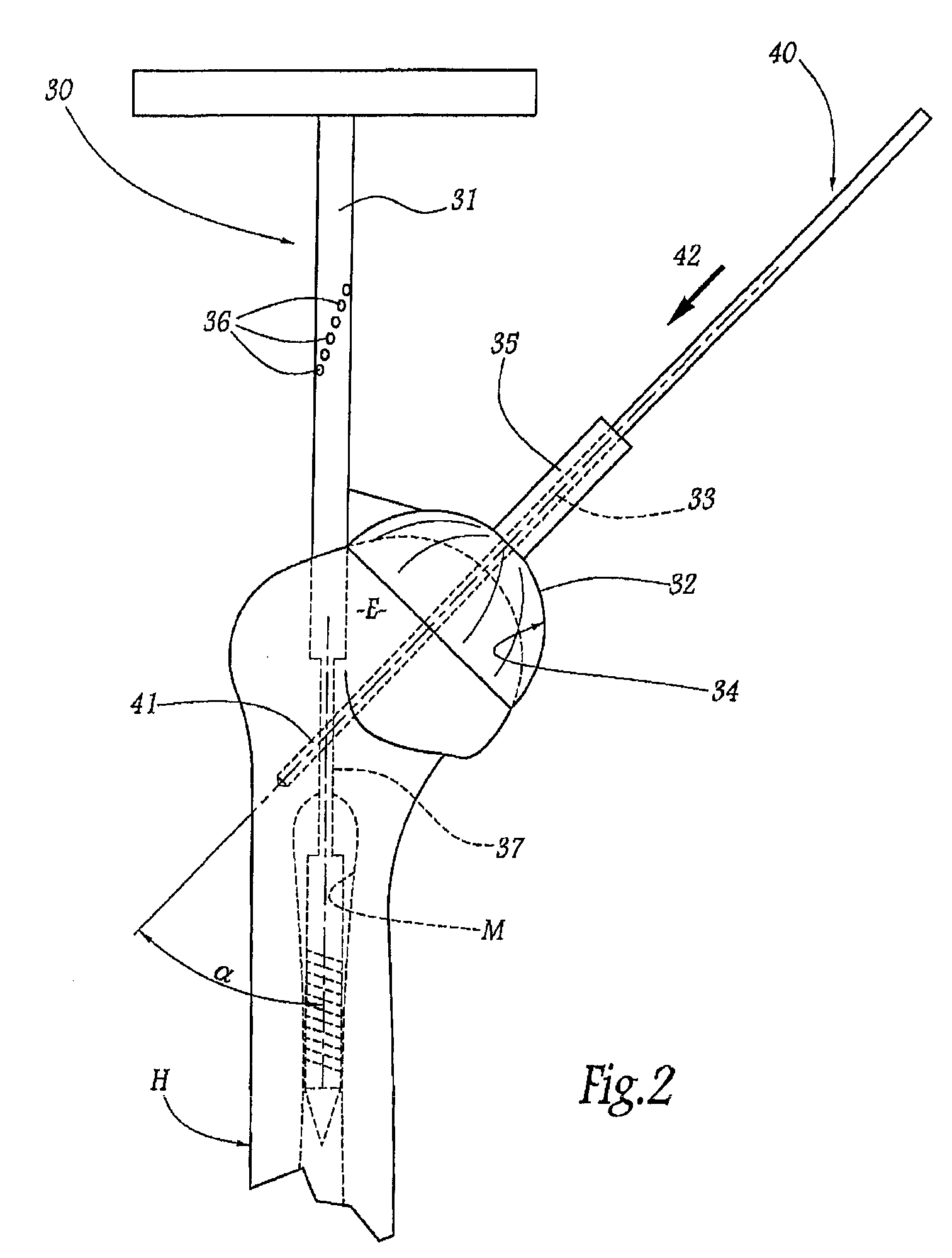 Method and apparatus for fitting a shoulder prosthesis