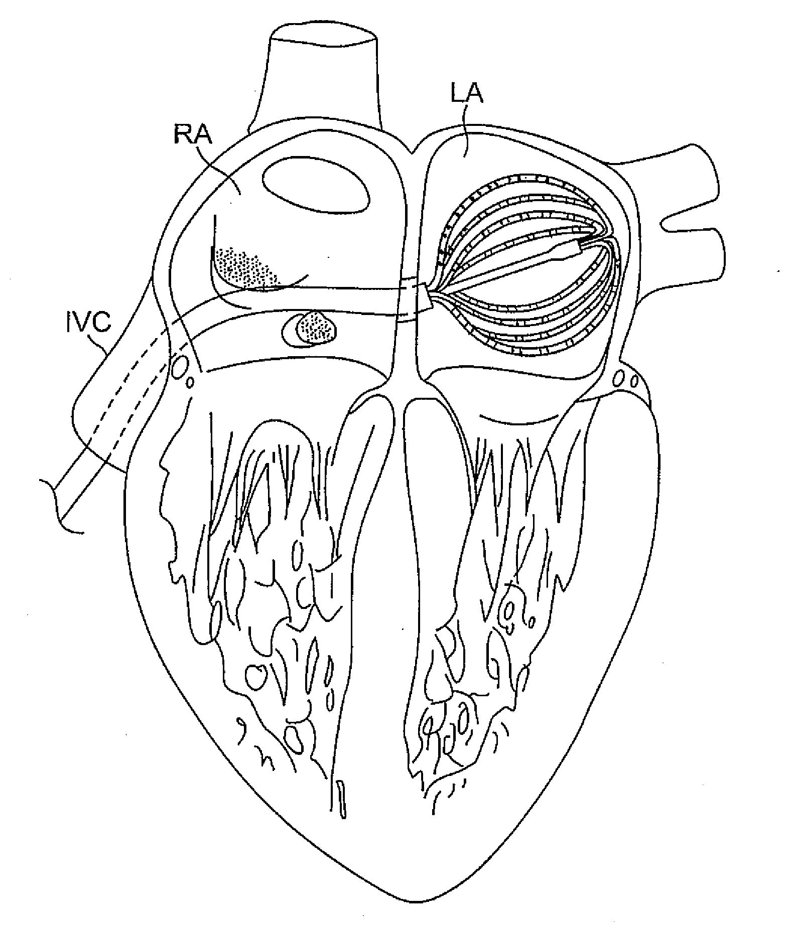 Basket catheter with deflectable spine