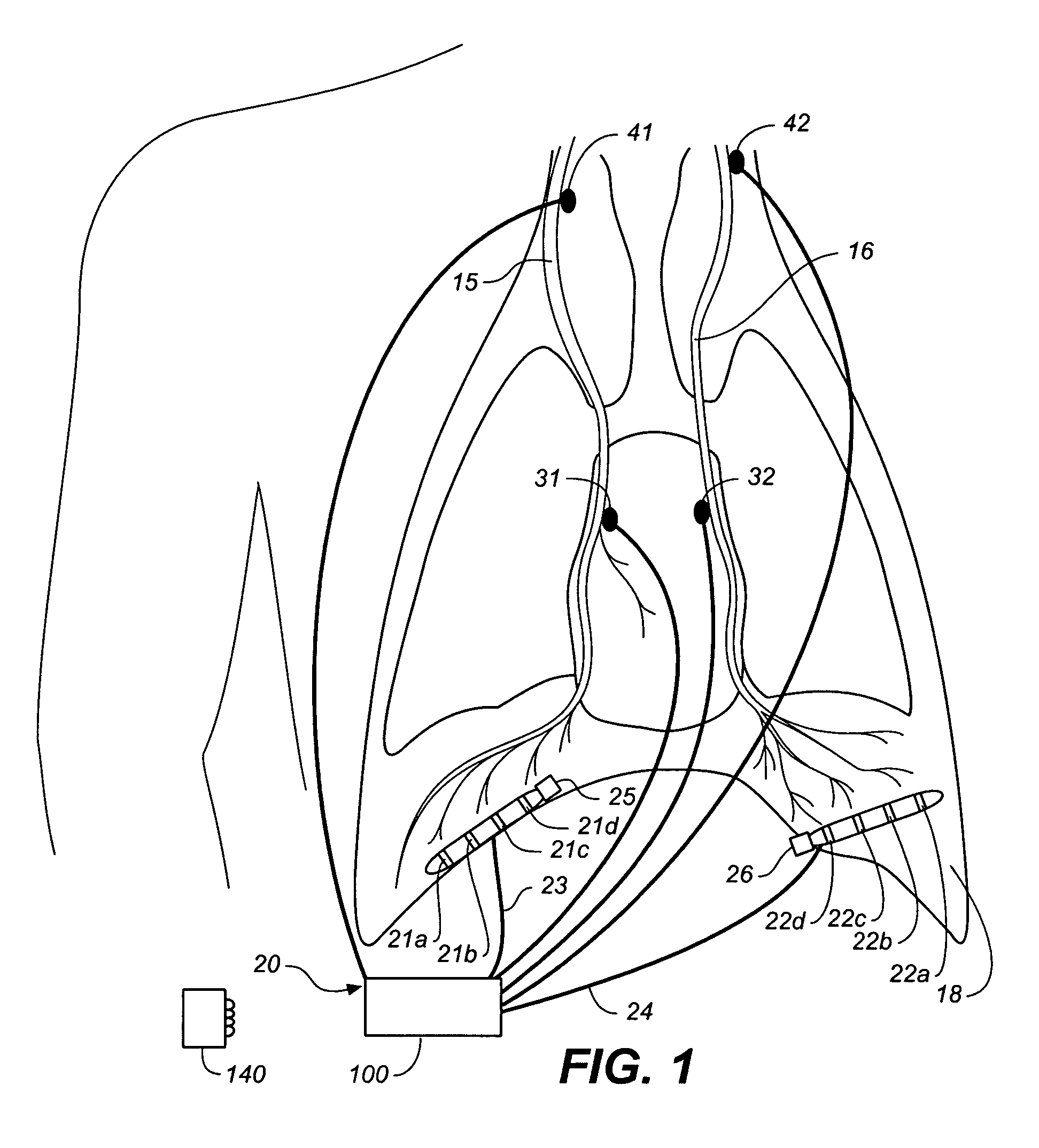 Device and method for biasing lung volume