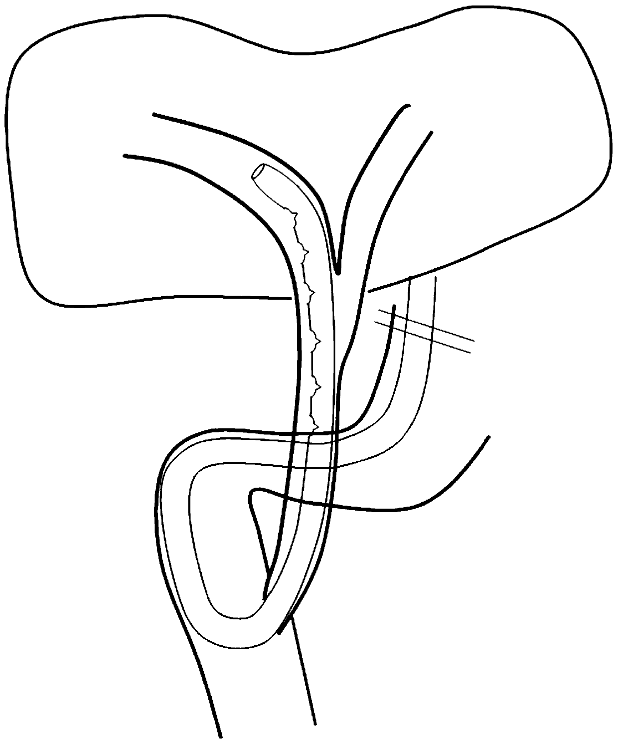 Reversed-a-shaped nasobiliary drainage tube