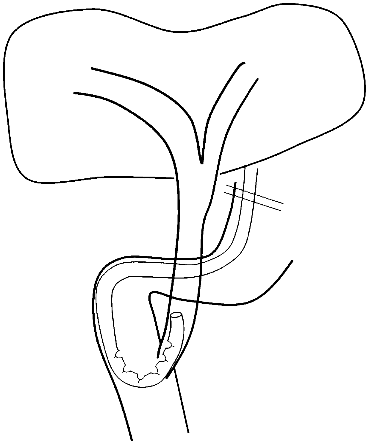 Reversed-a-shaped nasobiliary drainage tube