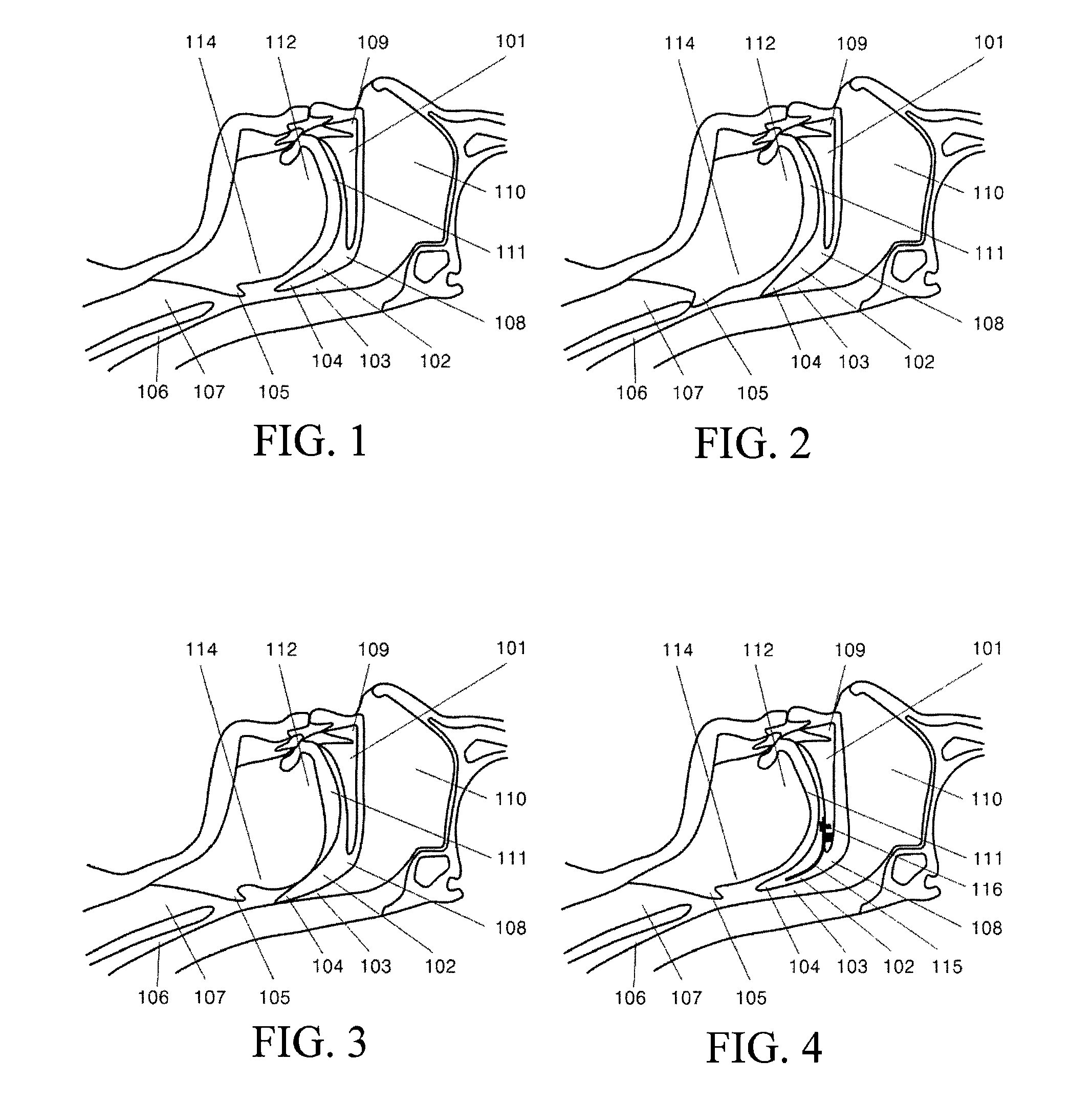 Adjustable Support for Soft Palate and Implanting Method thereof