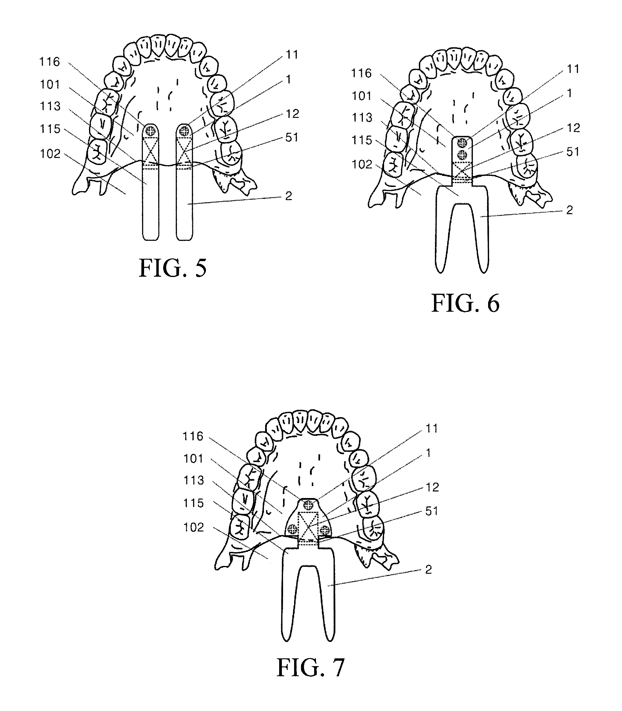 Adjustable Support for Soft Palate and Implanting Method thereof