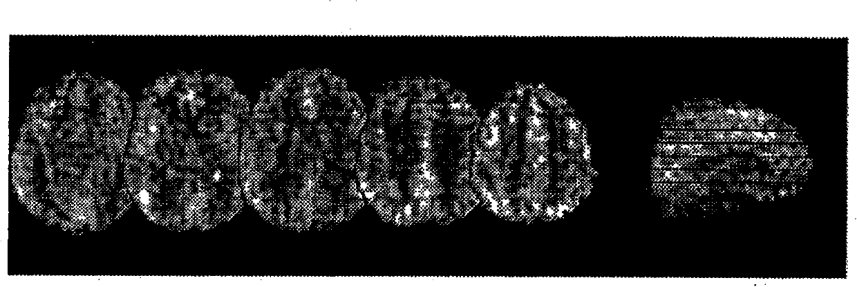 Methods for treating disorders using nmda nr2b-subtype selective antagonist