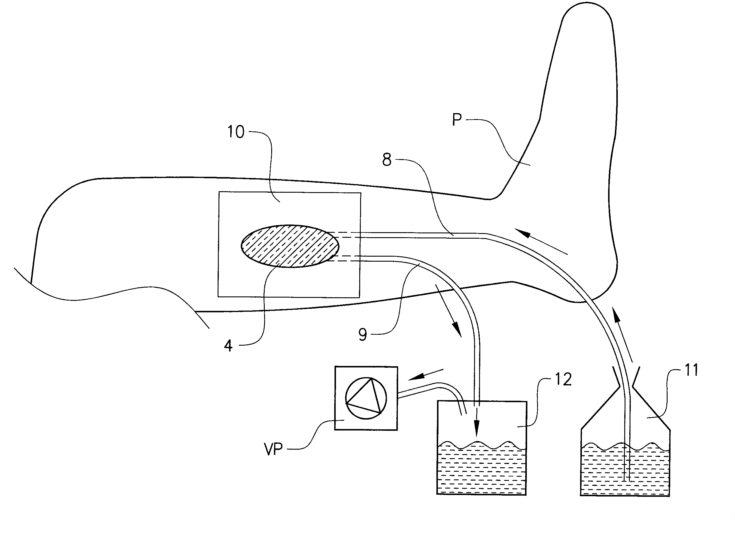 Irrigation dressing and method of applying such an irrigating dressing