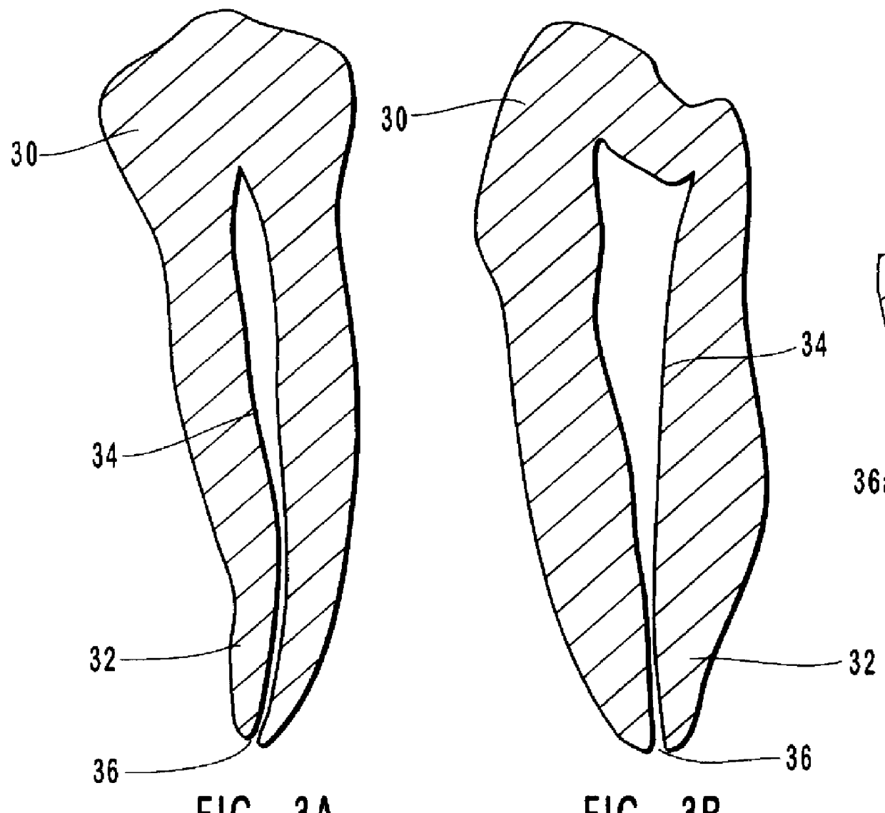 Endodontic methods for the anatomical, sectional and progressive corono-apical preparation of root canals with three sets of dedicated instruments