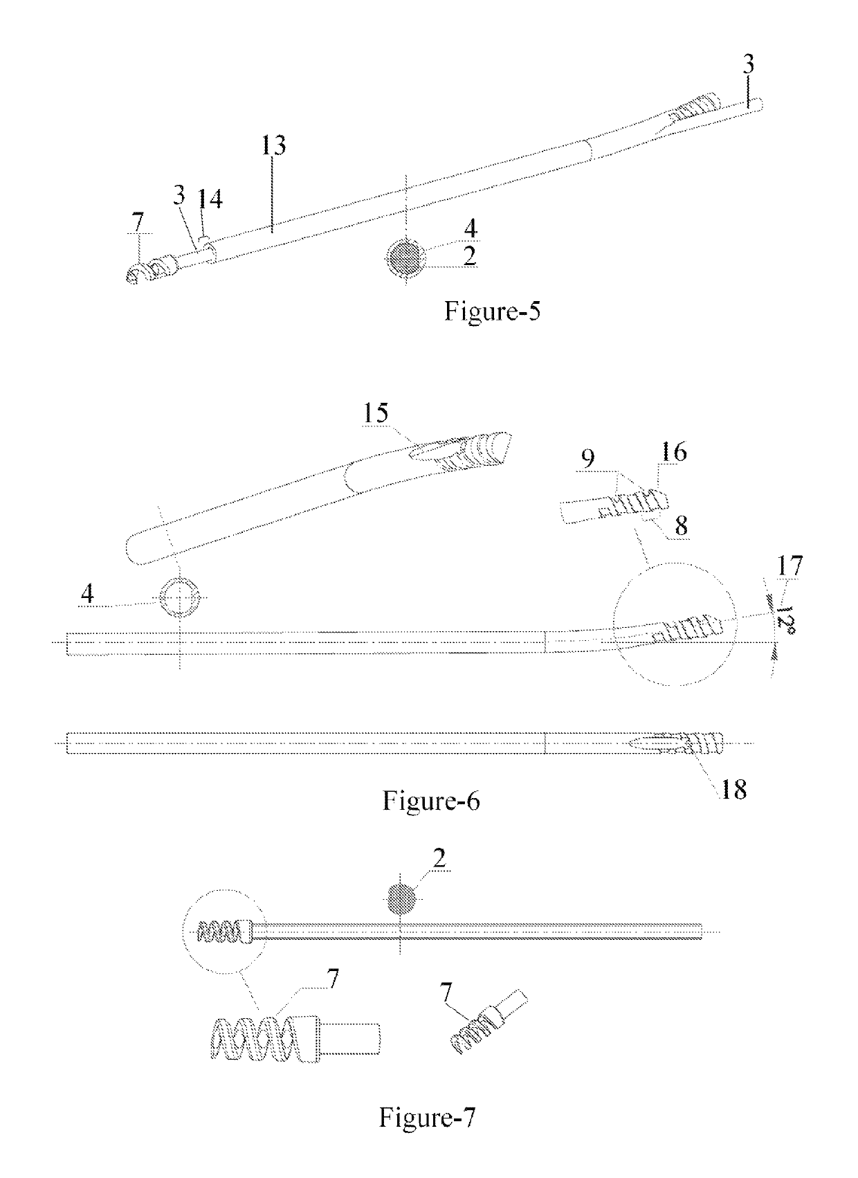 Telescopic nail