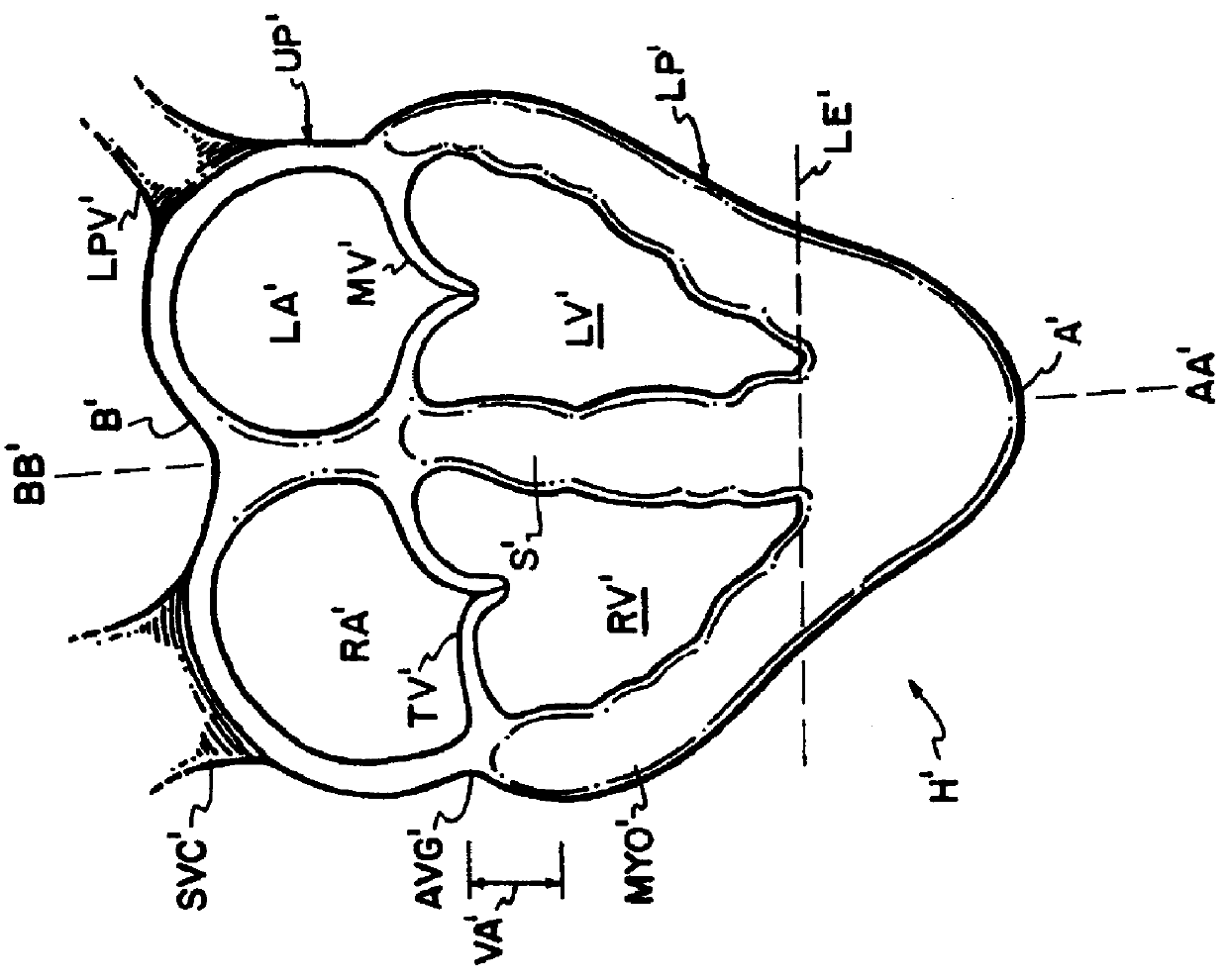 Cardiac disease treatment and device