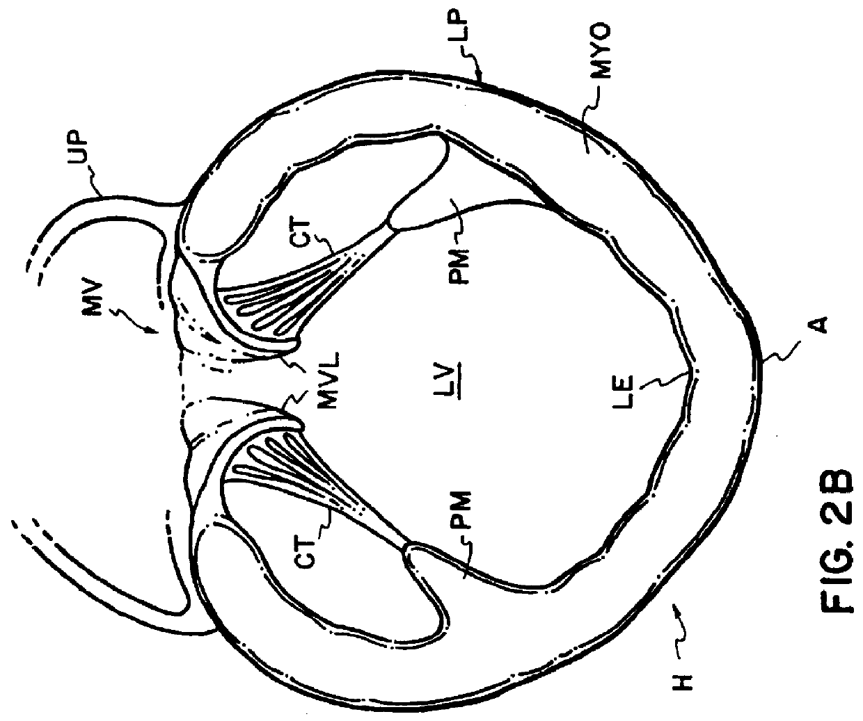 Cardiac disease treatment and device