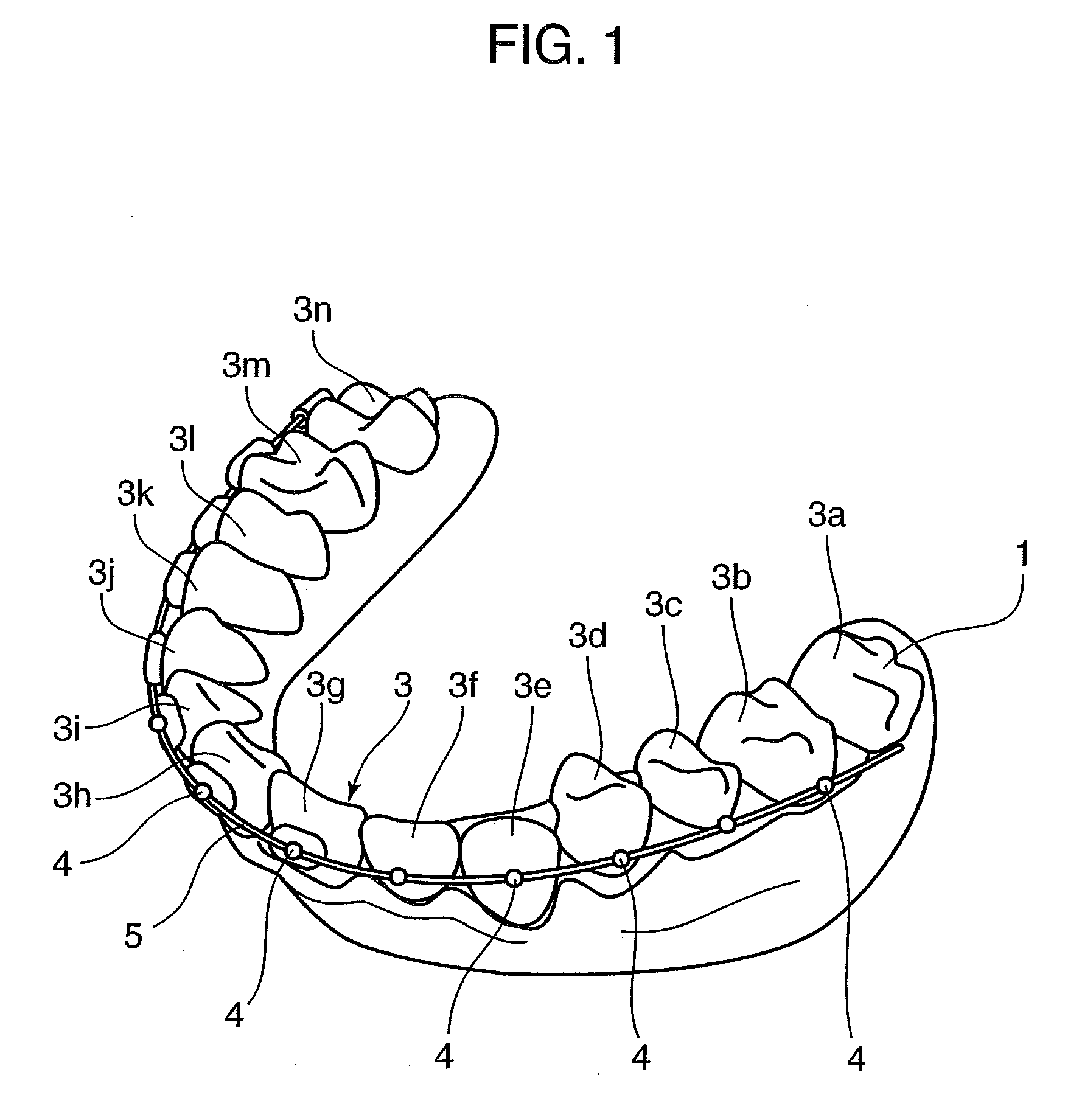 Orthodontic Appliance