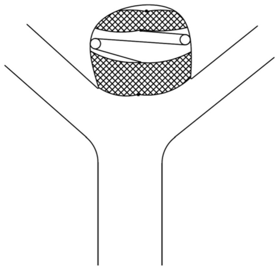 Aneurysm embolism device