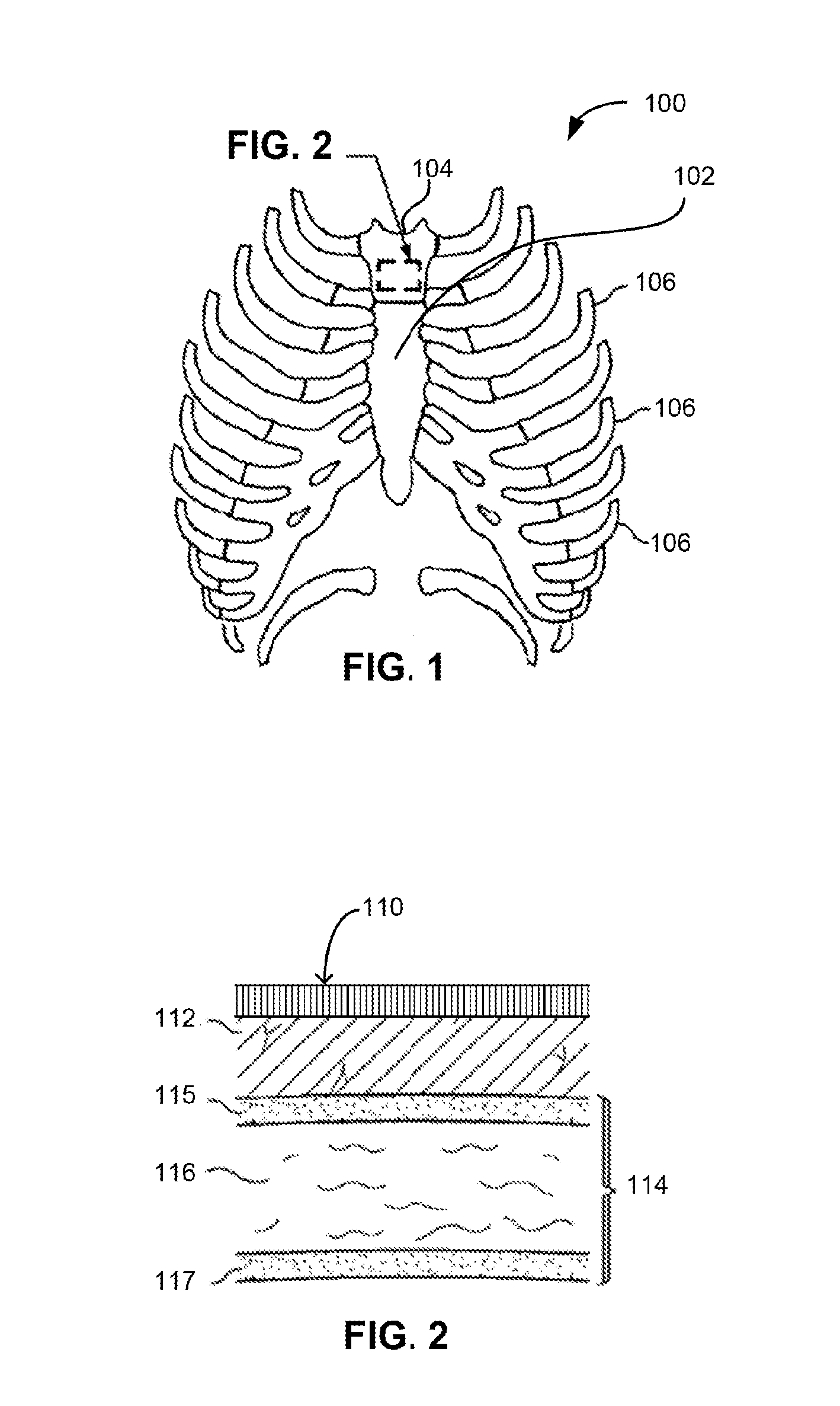 Sternal locators and associated systems and methods